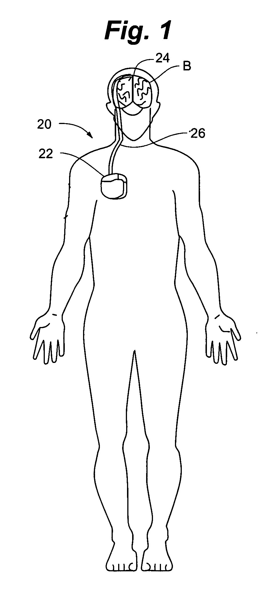 Division approximation for implantable medical devices