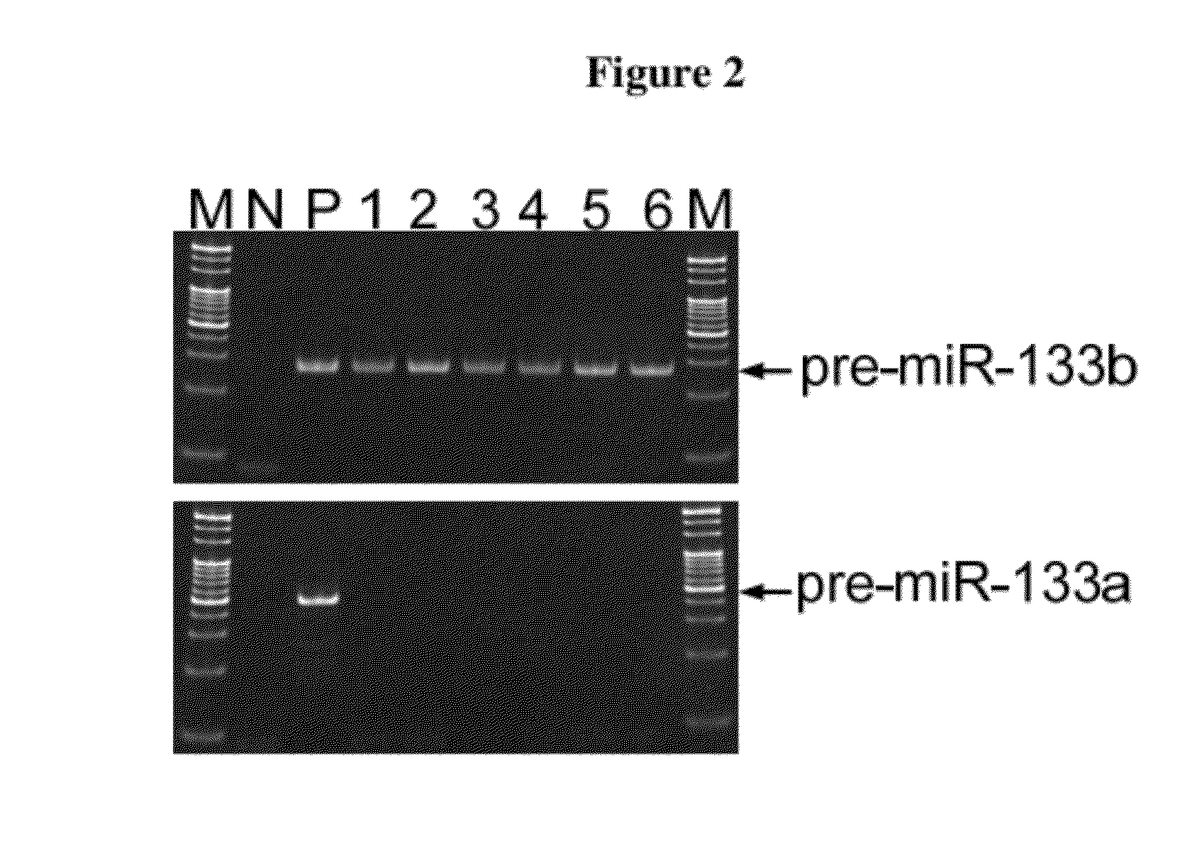 Methods and compositions for the diagnosis and prognosis of cervical intraepithelial neoplasia and cervical cancer