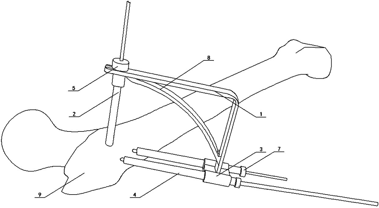 Proximal end of femur kirschner wire fixing device