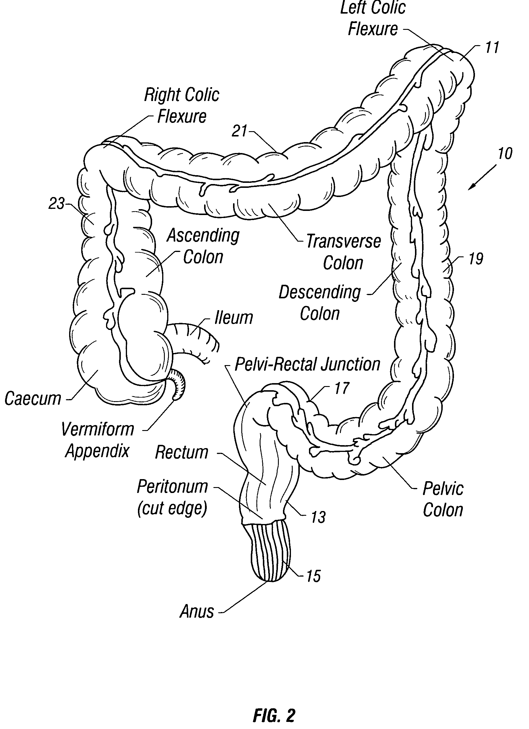 Therapeutic heating and cooling via temperature management of a colon-inserted balloon