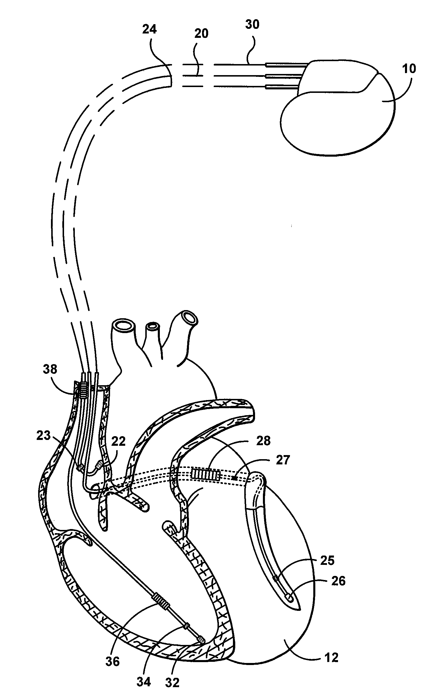 Multi-chamber ventricular automatic capture method and apparatus for minimizing true and blanking period induced ventricular undersensing