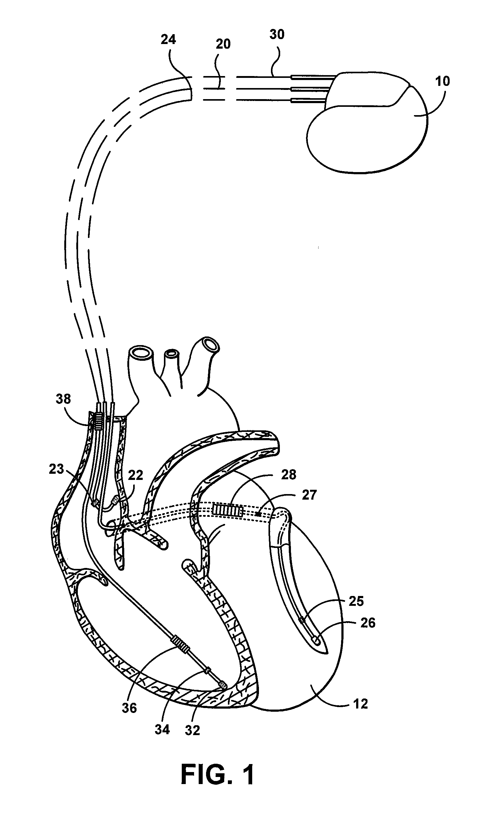 Multi-chamber ventricular automatic capture method and apparatus for minimizing true and blanking period induced ventricular undersensing