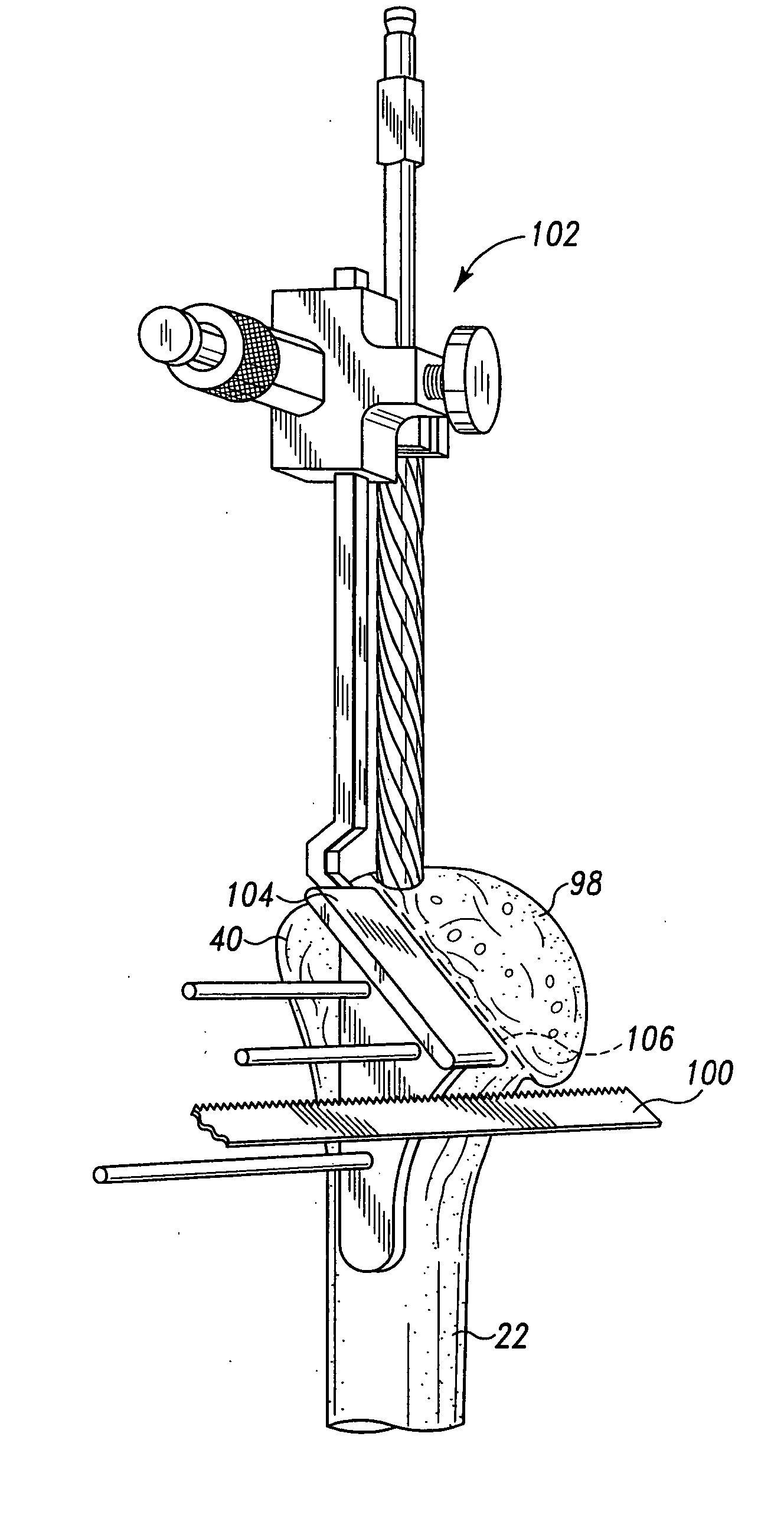 Bone resection apparatus