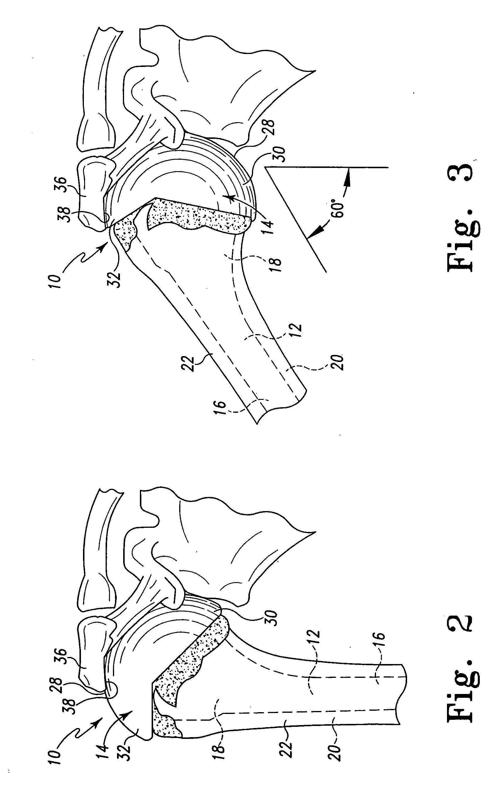 Bone resection apparatus