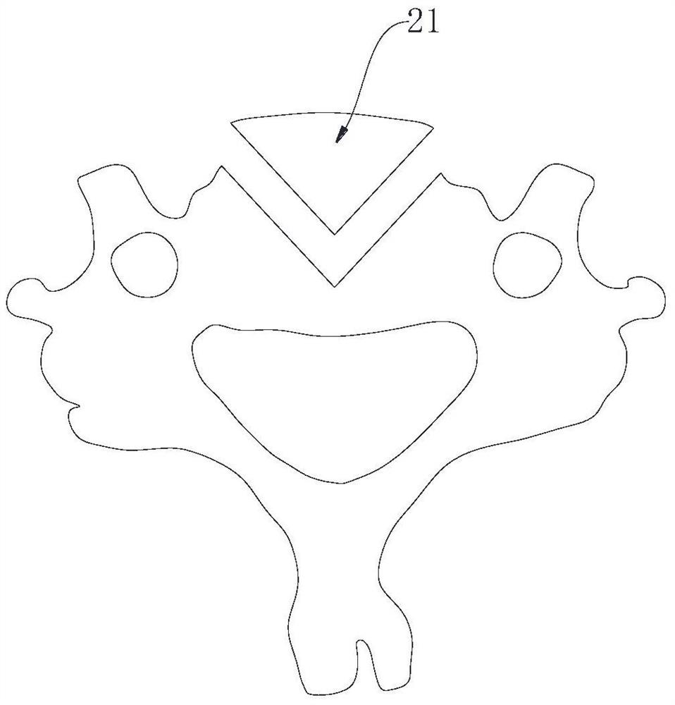 Intervertebral fusion fixator for X-shaped excision decompression vertebroplasty of vertebral body