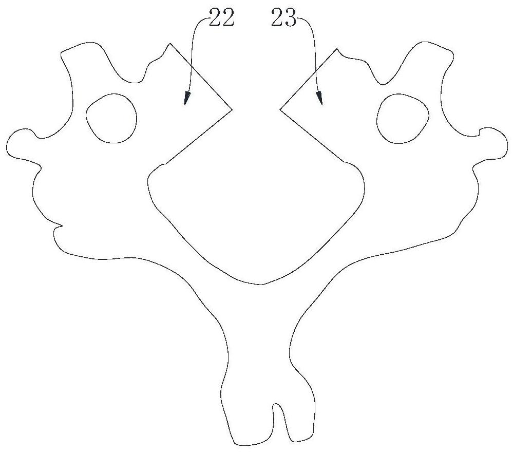 Intervertebral fusion fixator for X-shaped excision decompression vertebroplasty of vertebral body