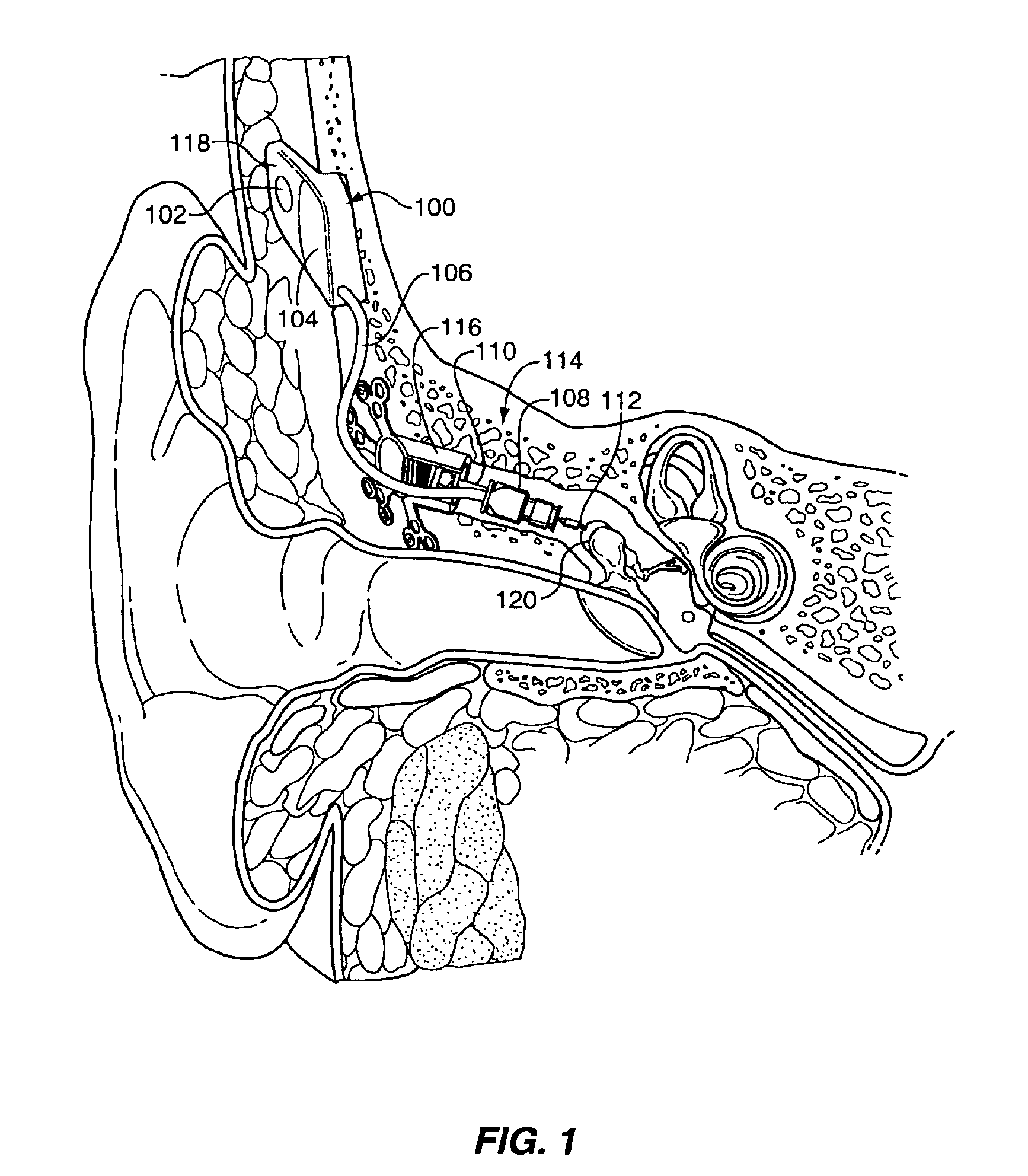 Implantable hearing aid transducer with actuator interface