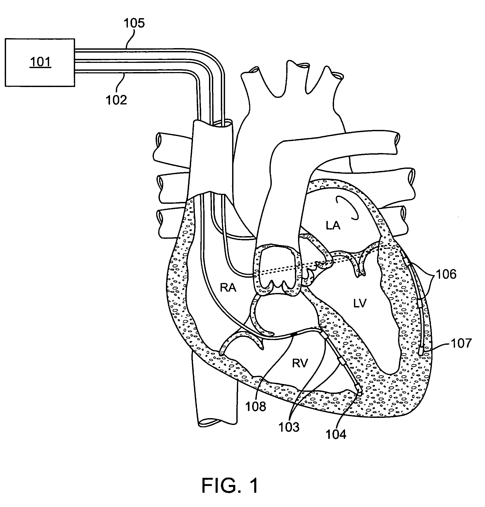 Methods and apparatus for leads for implantable devices