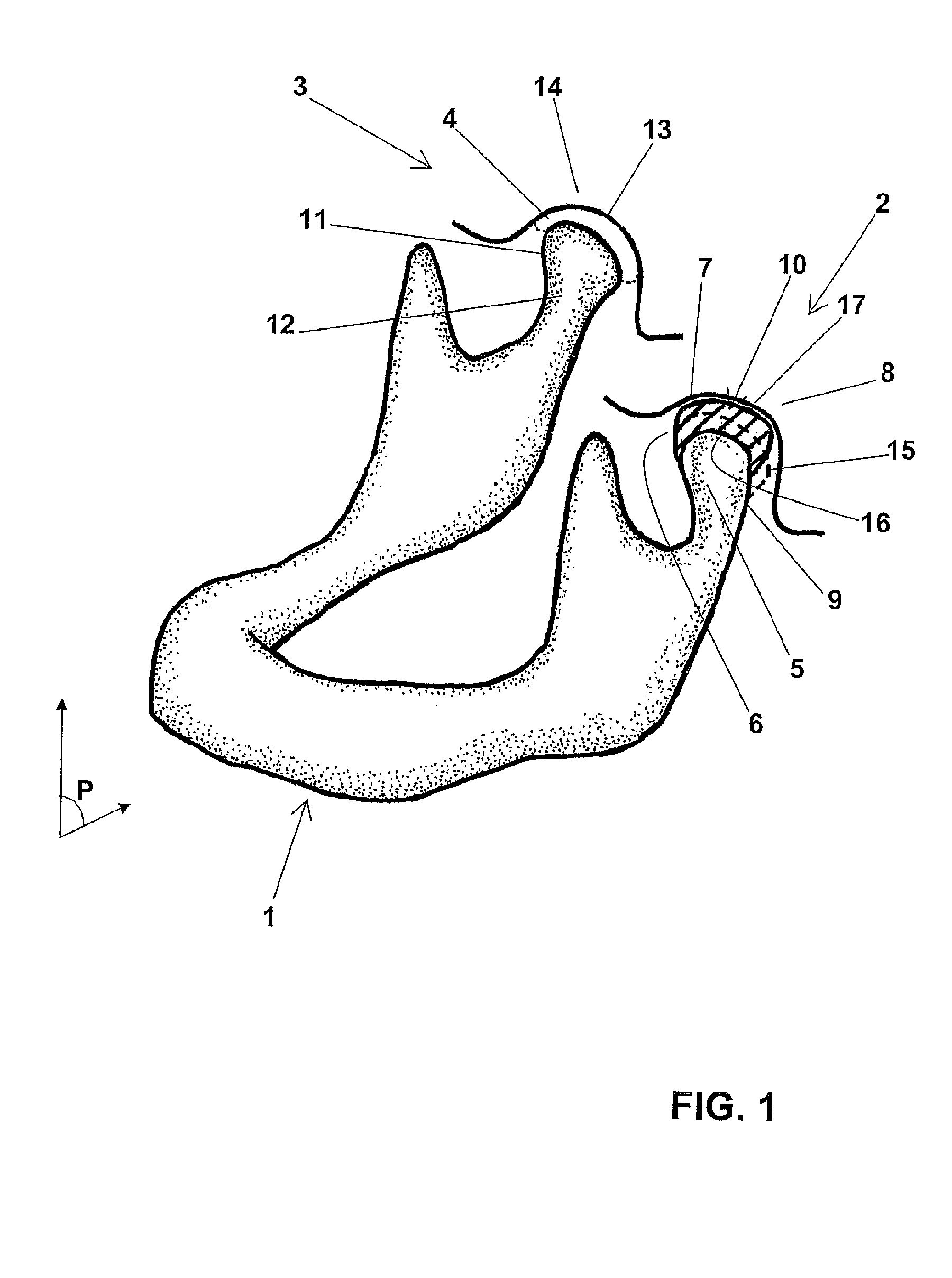 Temporomandibular prosthetic implant, and corresponding production method