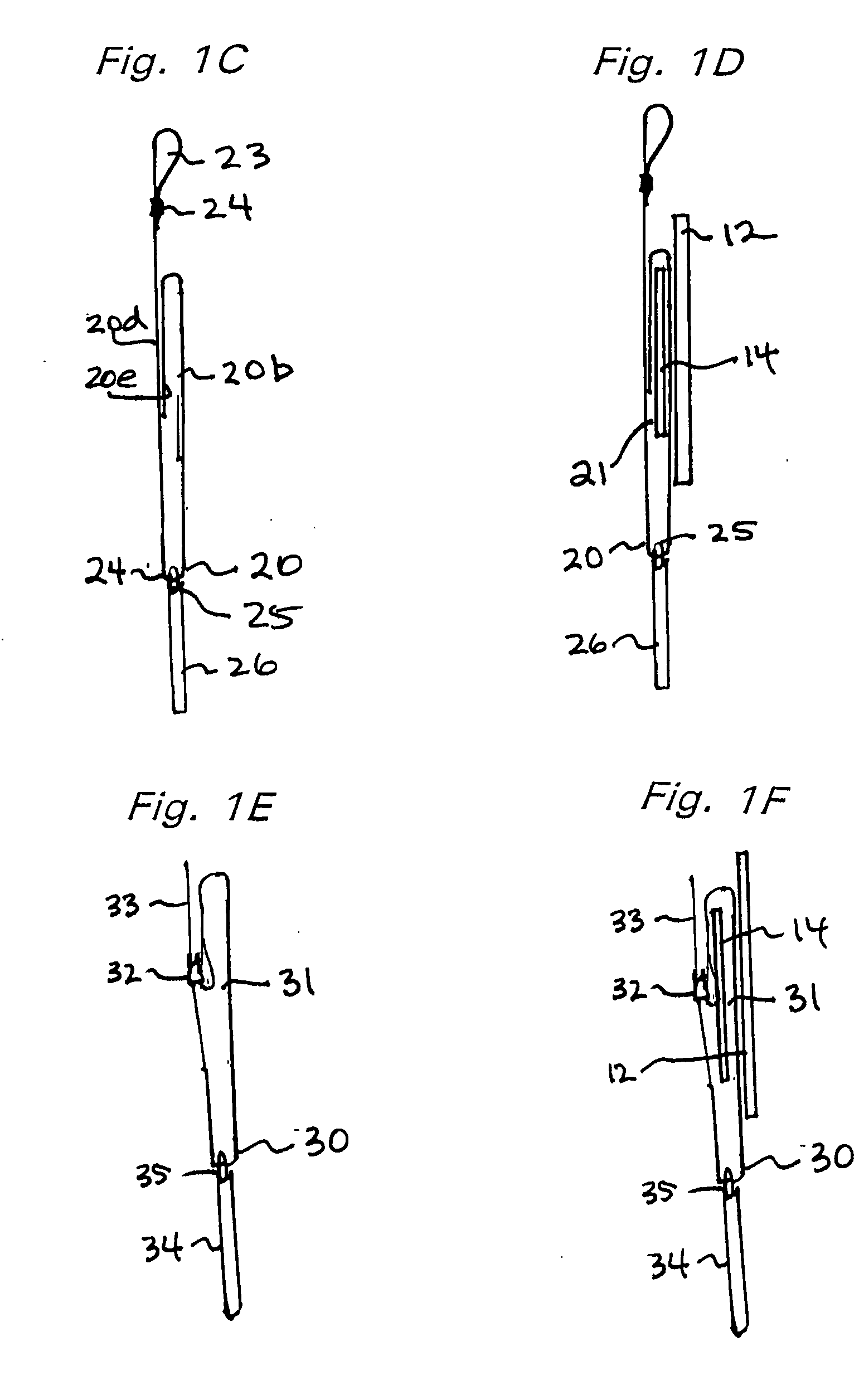 Foot eversion inhibitor