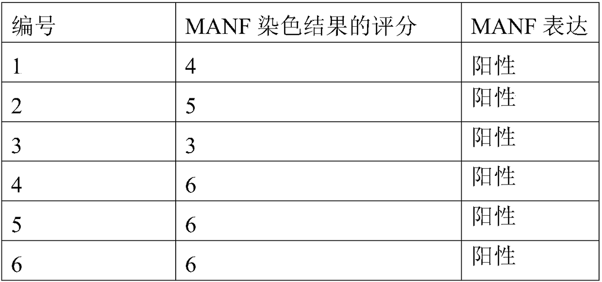 Products and methods for the identification of hepatocellular carcinoma and intrahepatic cholangiocarcinoma based on MANF as a marker