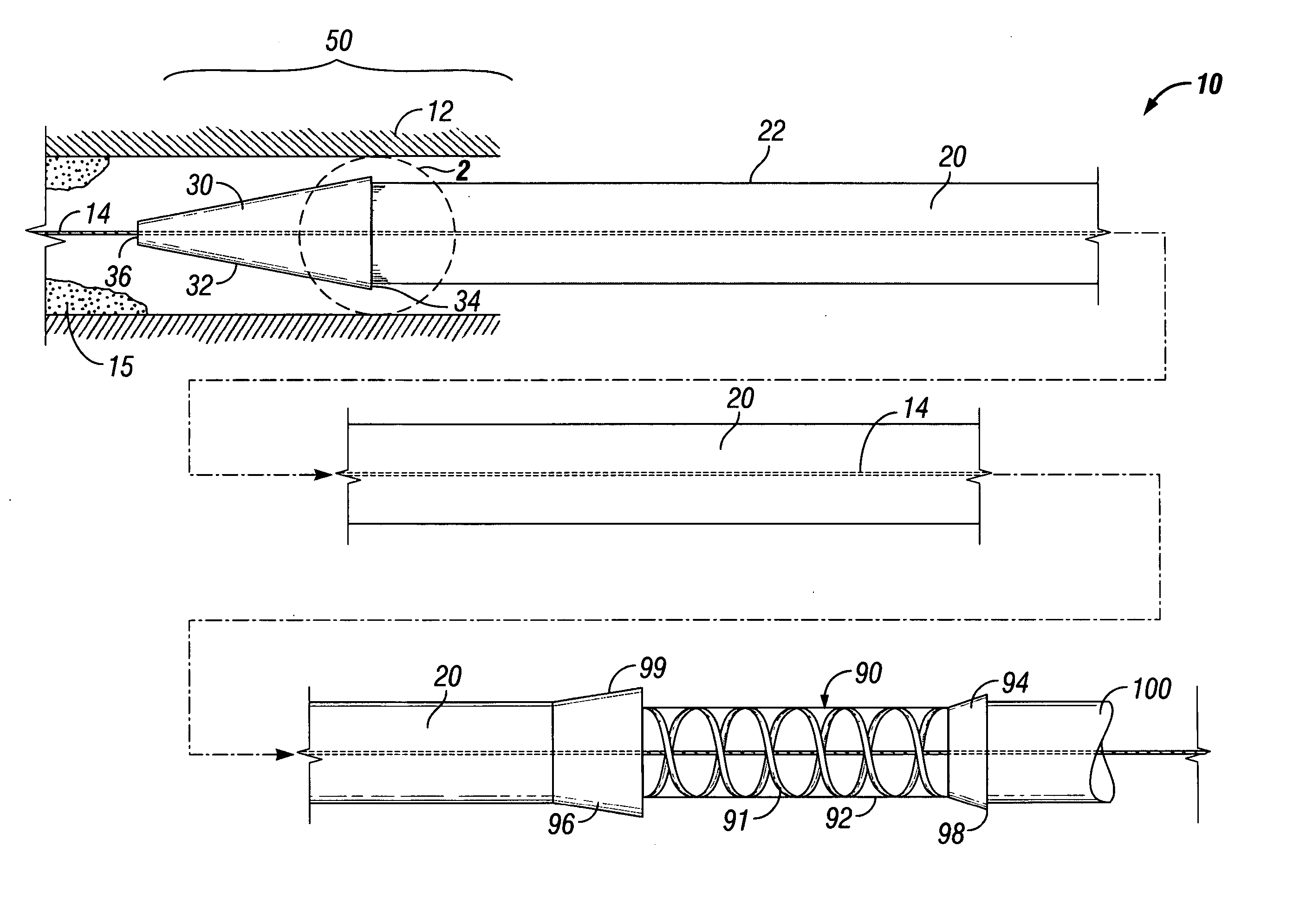 Esophageal dilation and stent delivery system and method of use