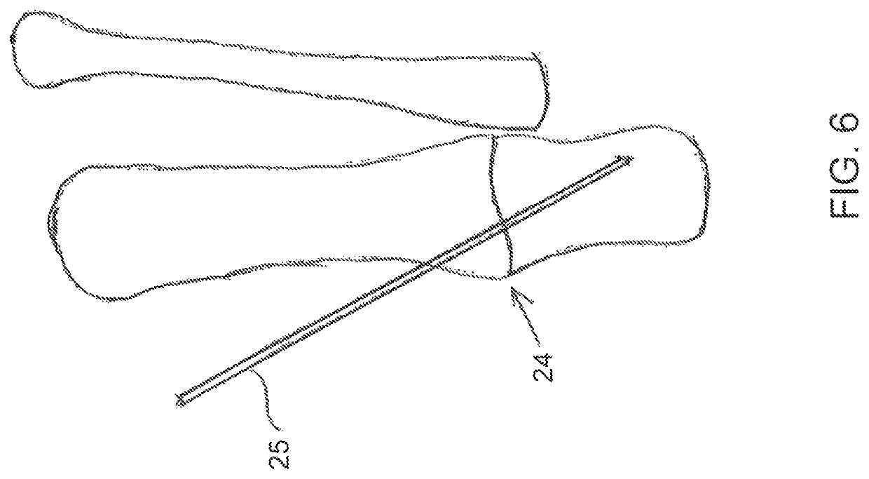 Arthrodesis surgical apparatus and method