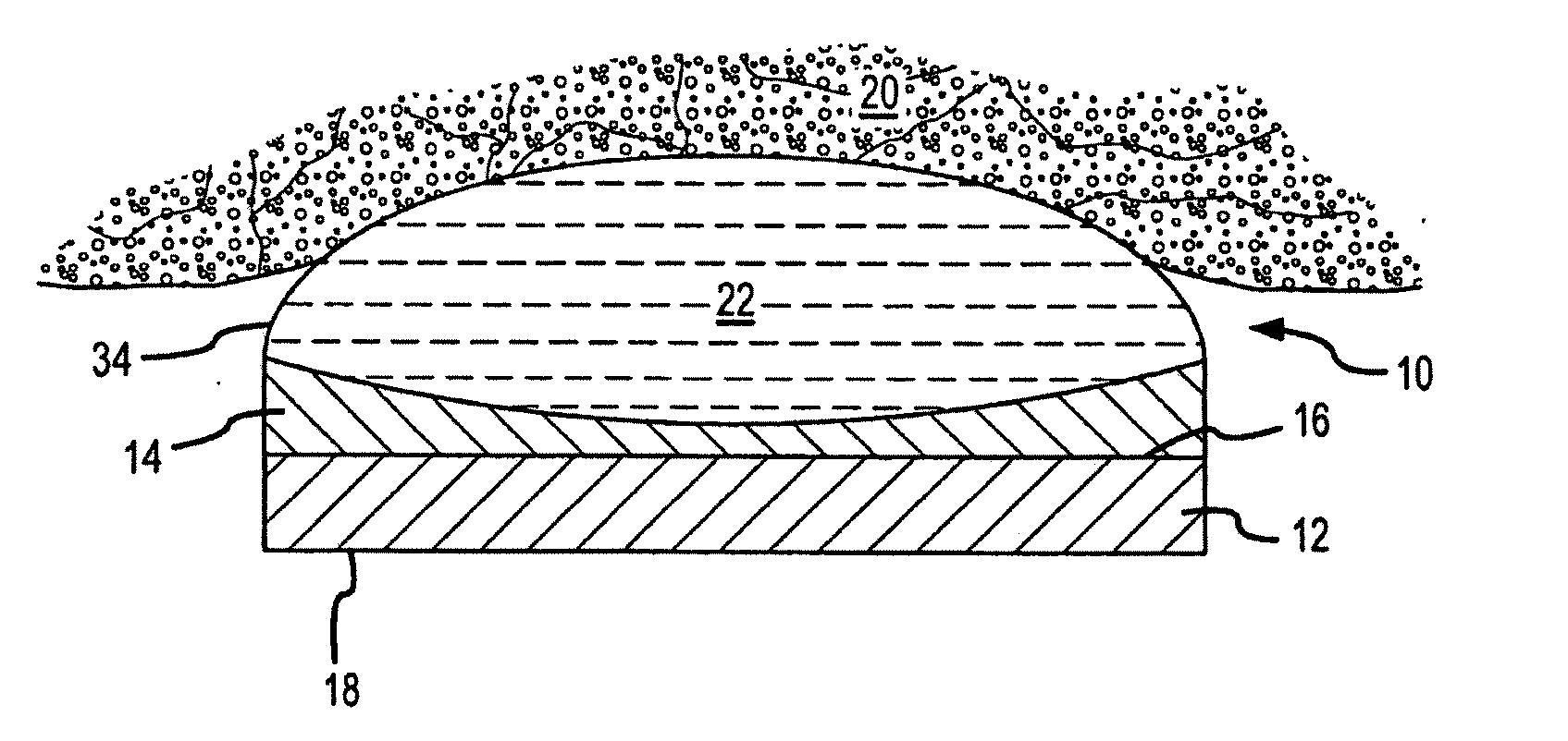 High intensity focused ultrasound transducer with acoustic lens