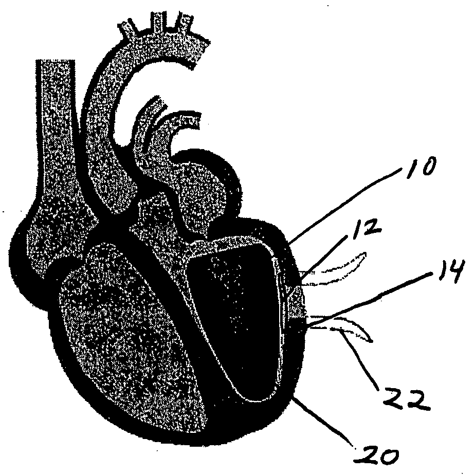 Shaping suture for treating congestive heart failure