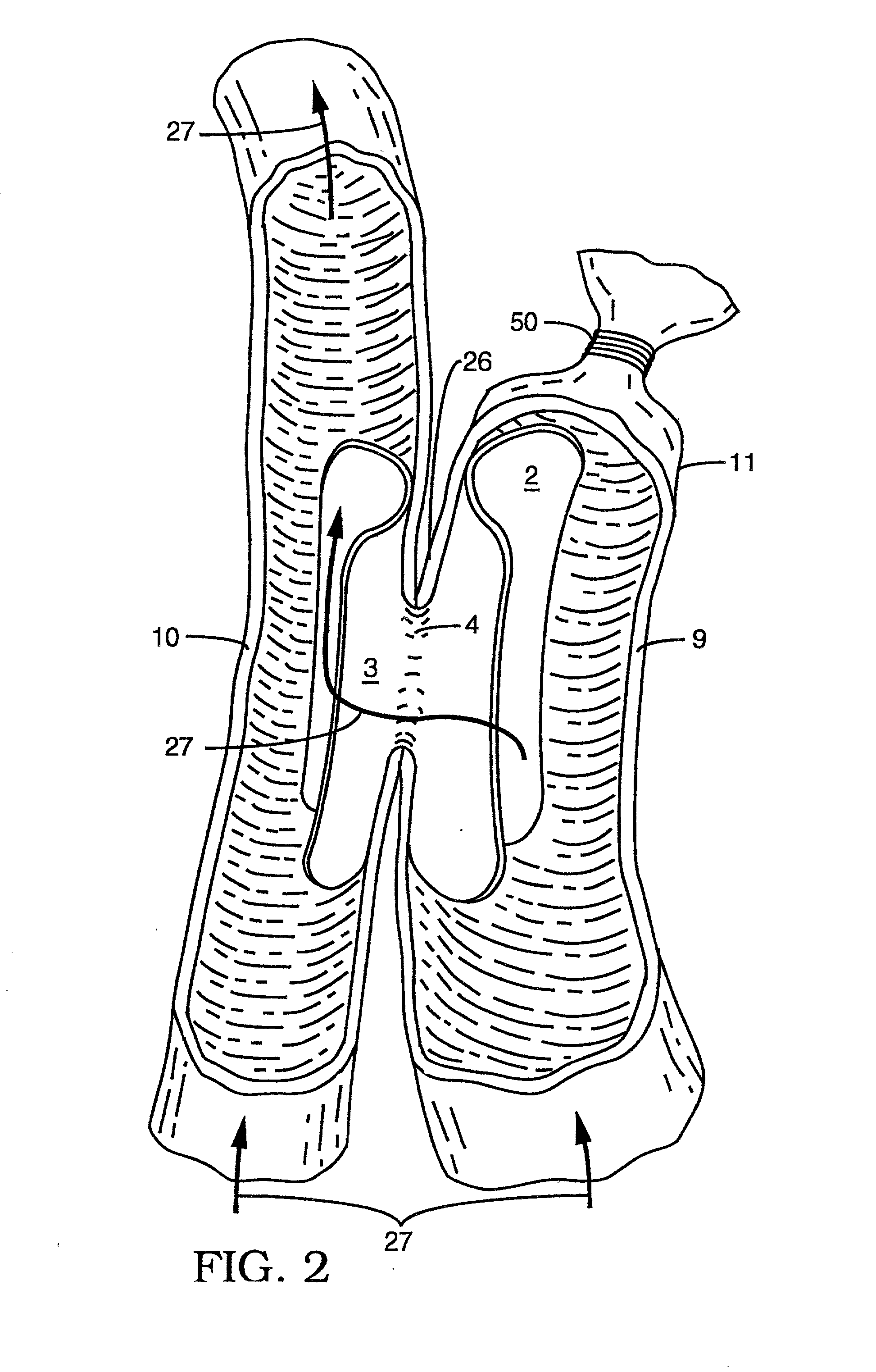 Devices and methods for interconnecting vessels