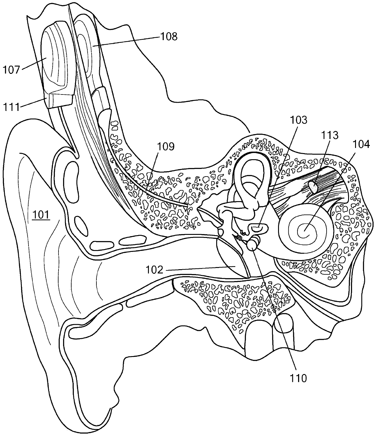 Middle ear implant for otosclerosis