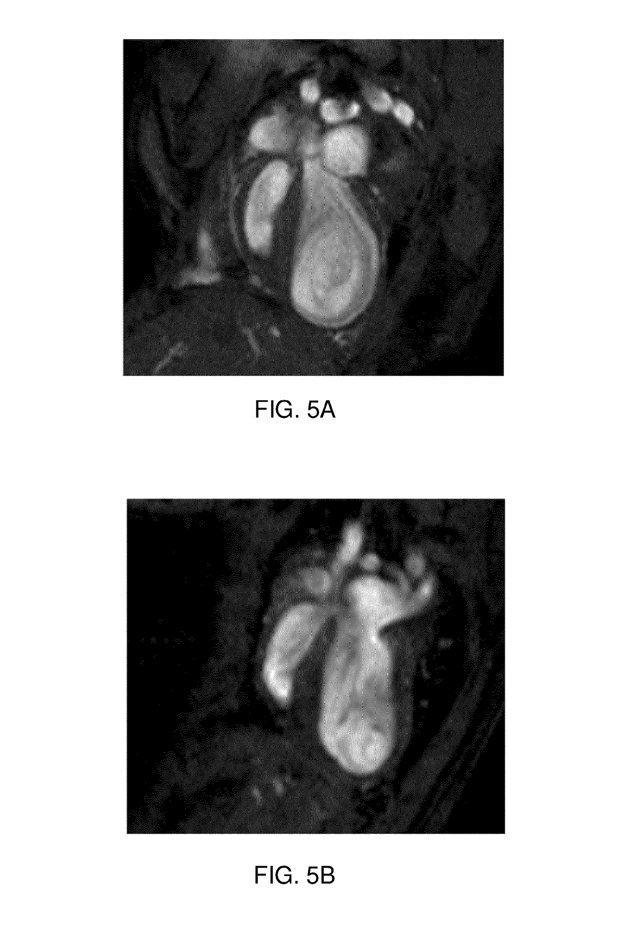 Immunoglobulin-like molecules directed against fibronectin-EDA