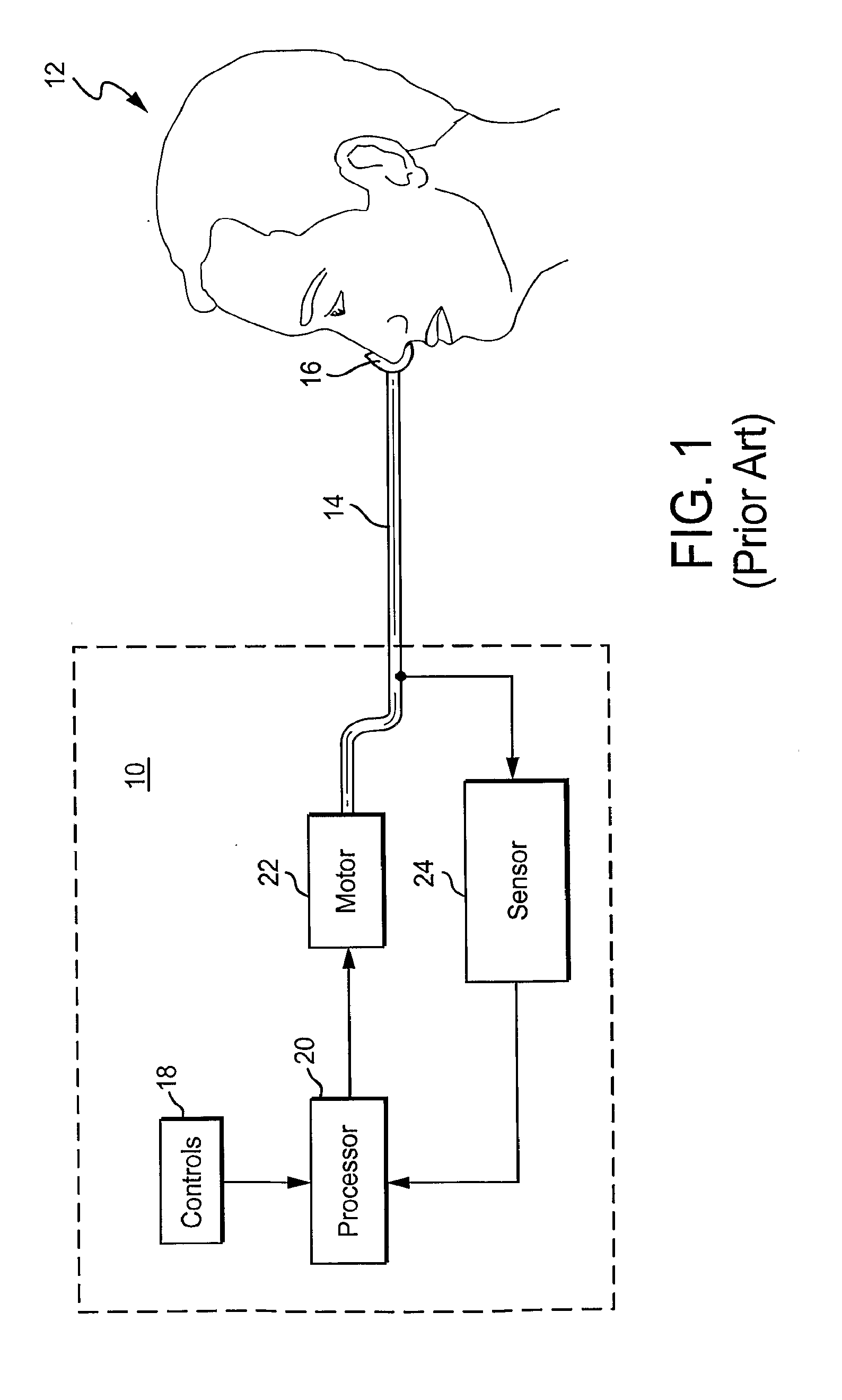 Method and apparatus for treating apnea/hypopnea