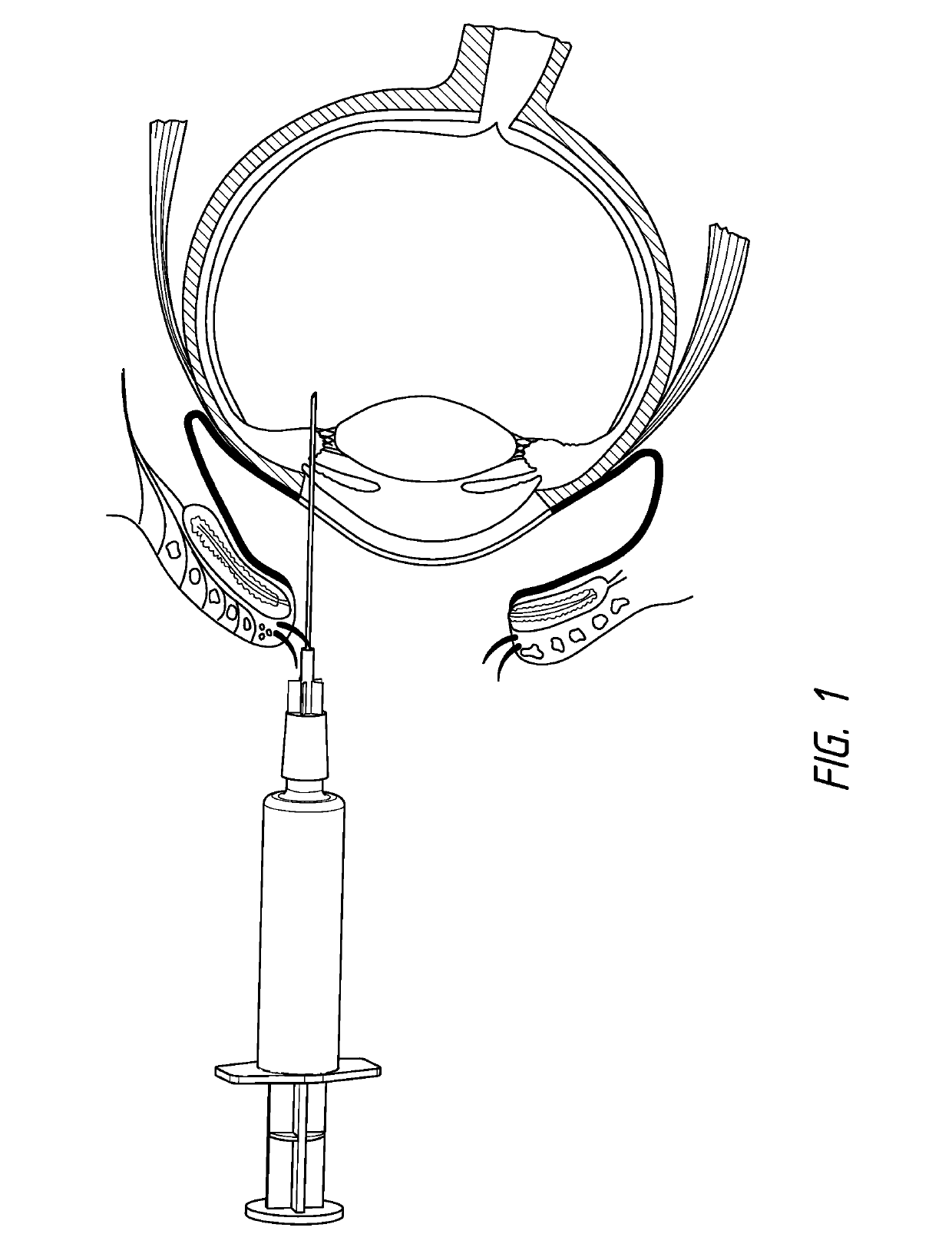 Method of treating AMD in patients refractory to anti-VEGF therapy