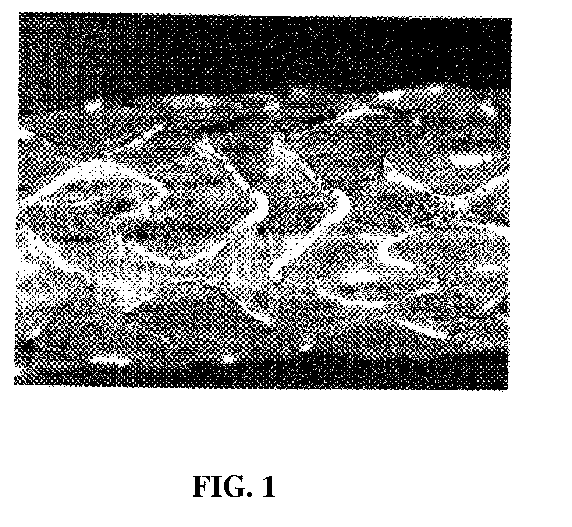 Helical hybrid stent