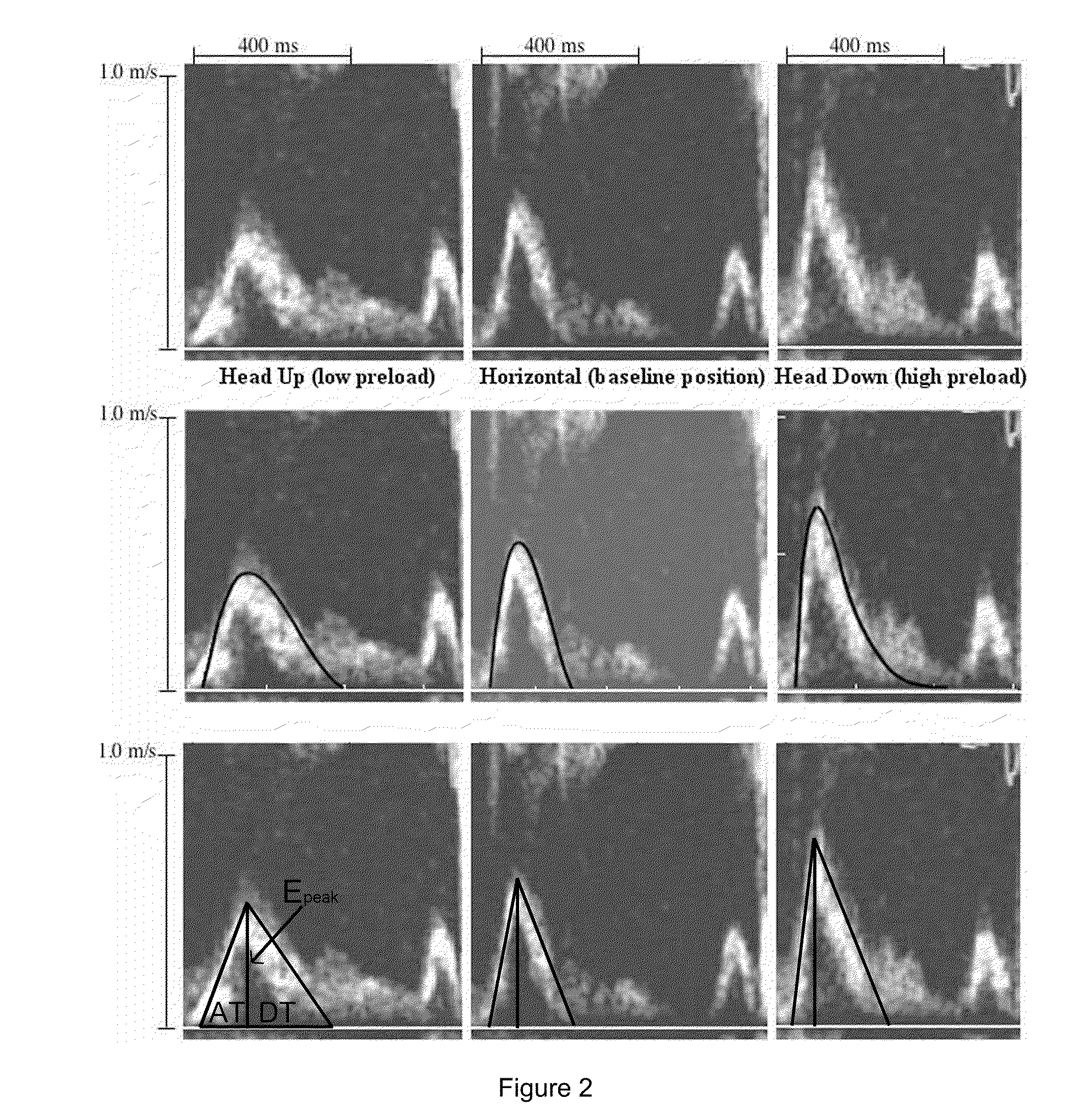 Load independent index of diastolic function