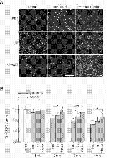 Application of sodium valproate in preparation of medicament for treating or improving optic nerve pathological changes of glaucoma