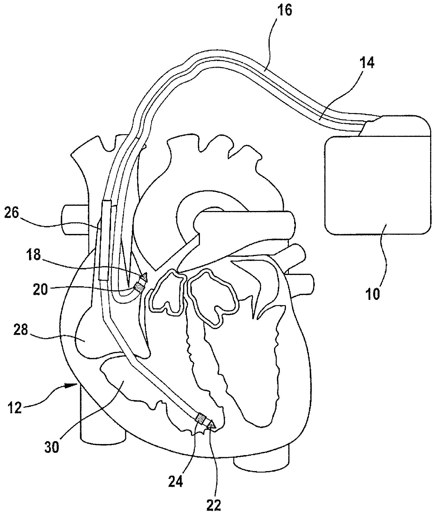 Atrial defibrillator