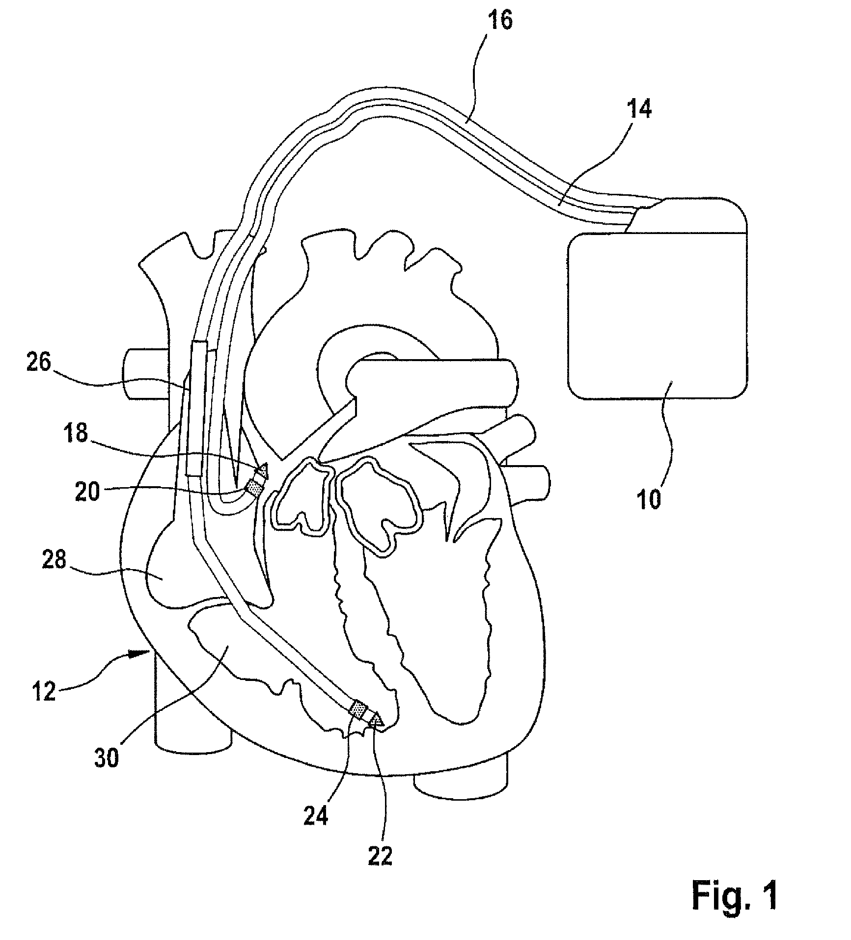 Atrial defibrillator