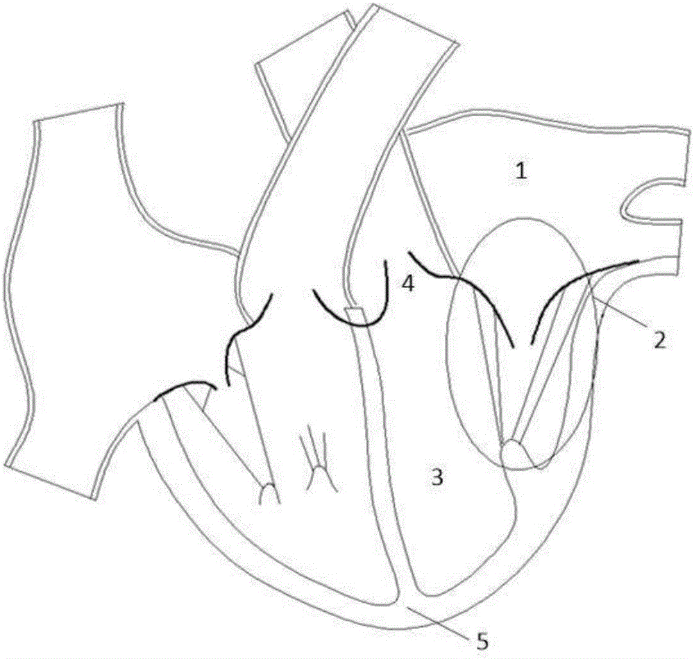 Strut type bicuspid valve airbag closing plate obstruction body implanted through cardiac apex, and implantation method thereof