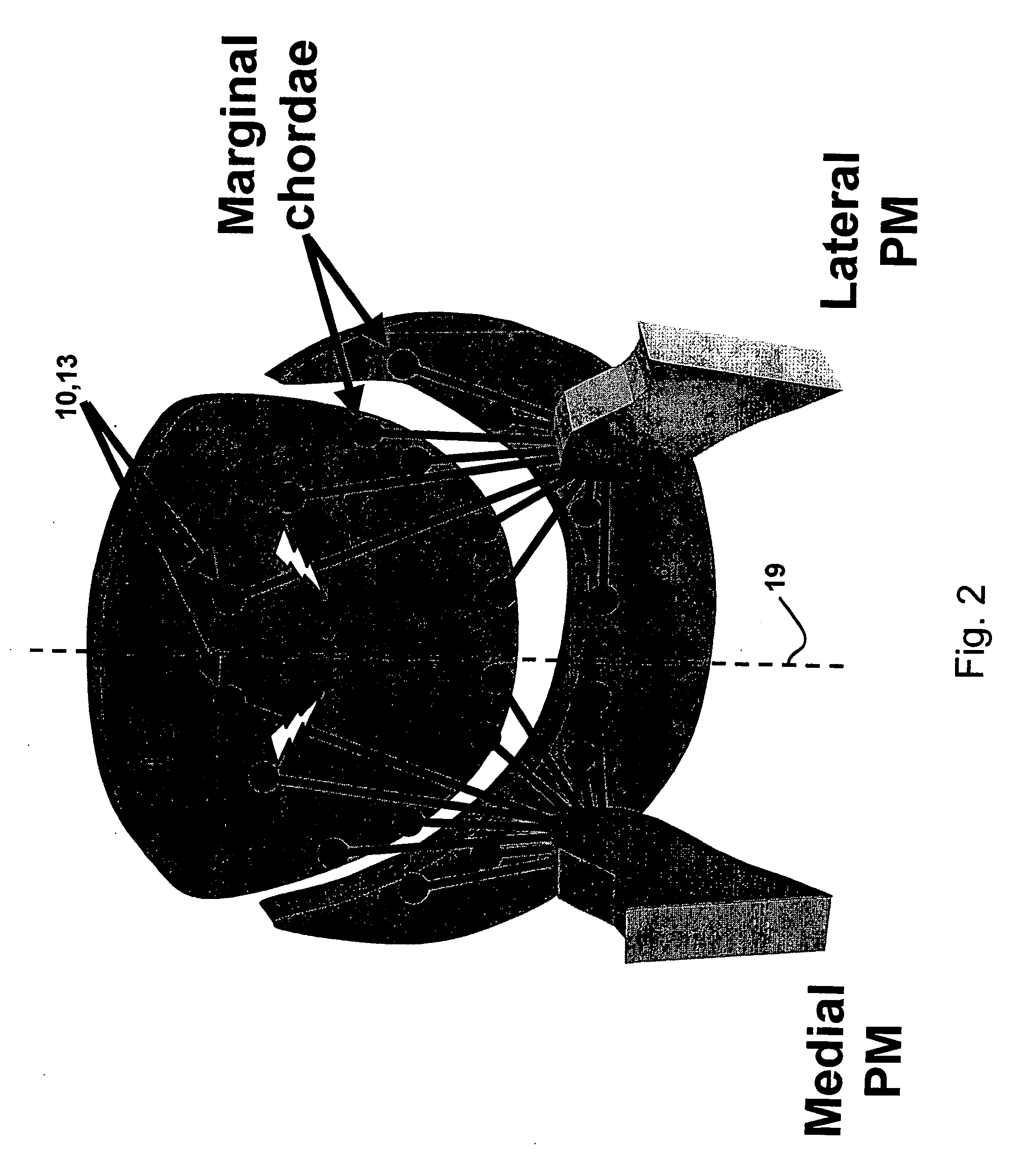 Cardiac devices and methods for minimally invasive repair of ischemic mitral regurgitation