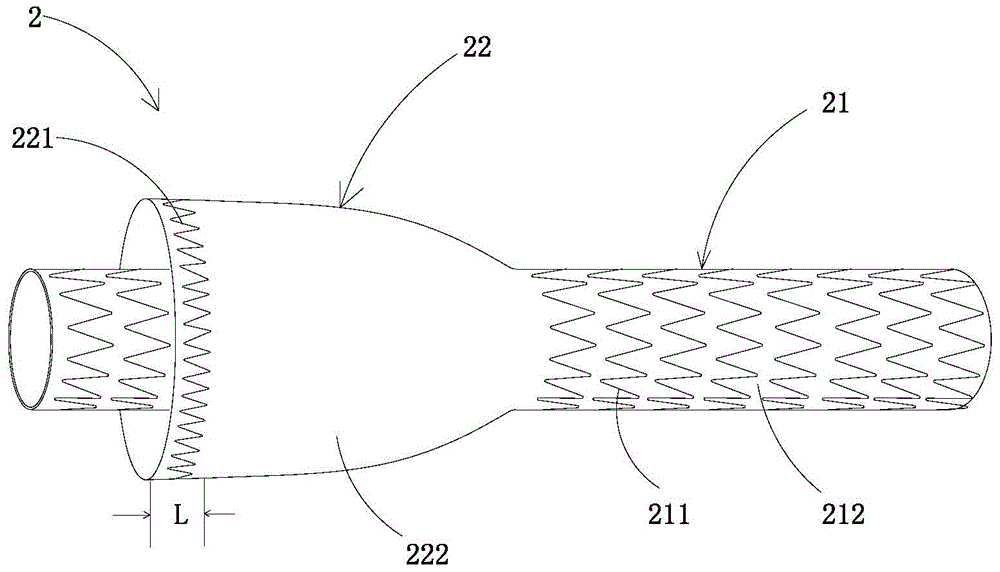 Lumen stent