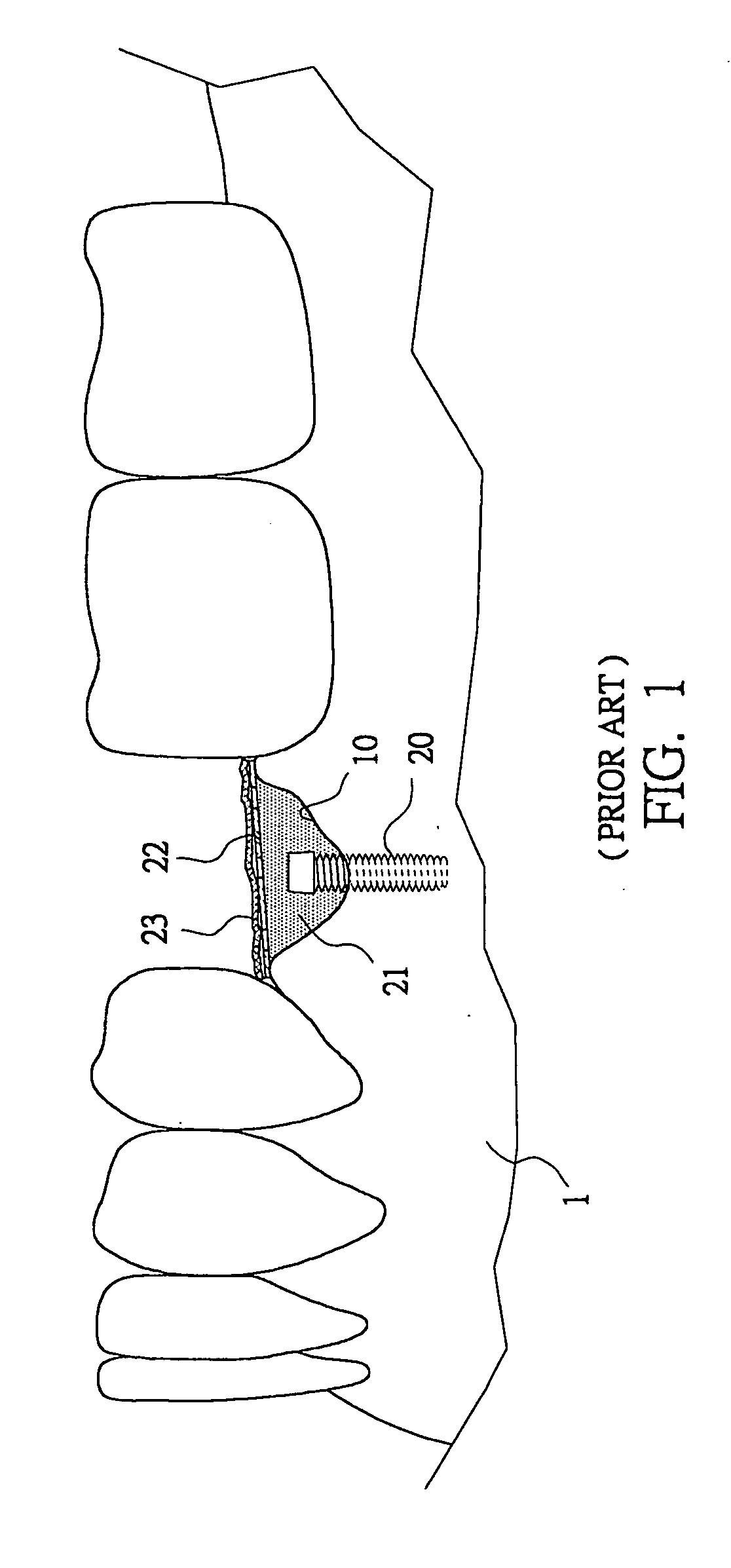 Titanium-mesh umbrella device for bone grafting