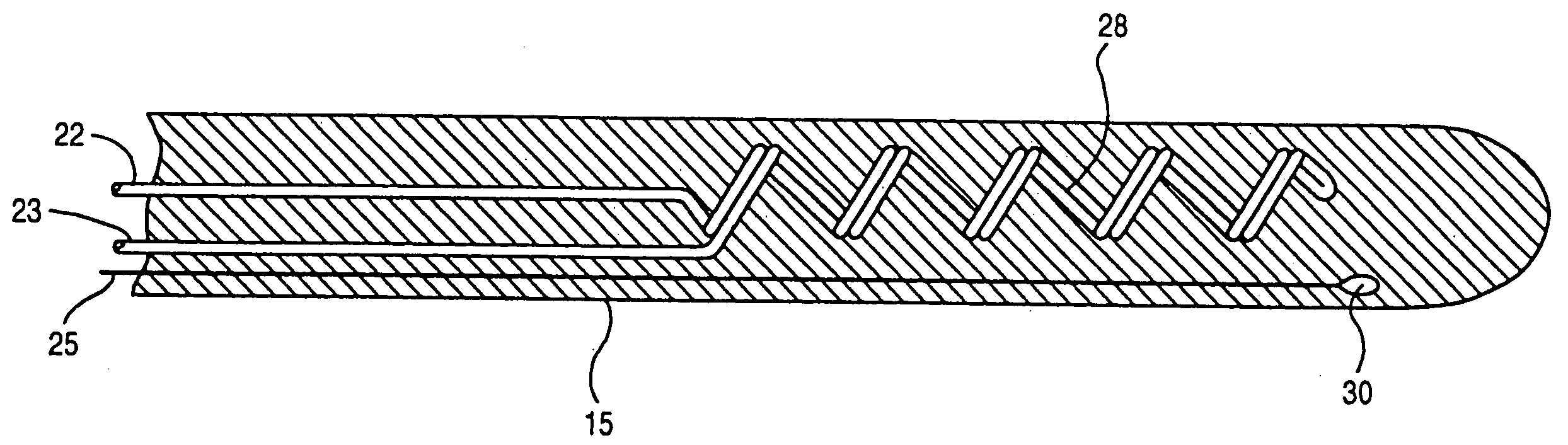 Method and apparatus for controlling a patient's body temperature by in situ blood temperature modification