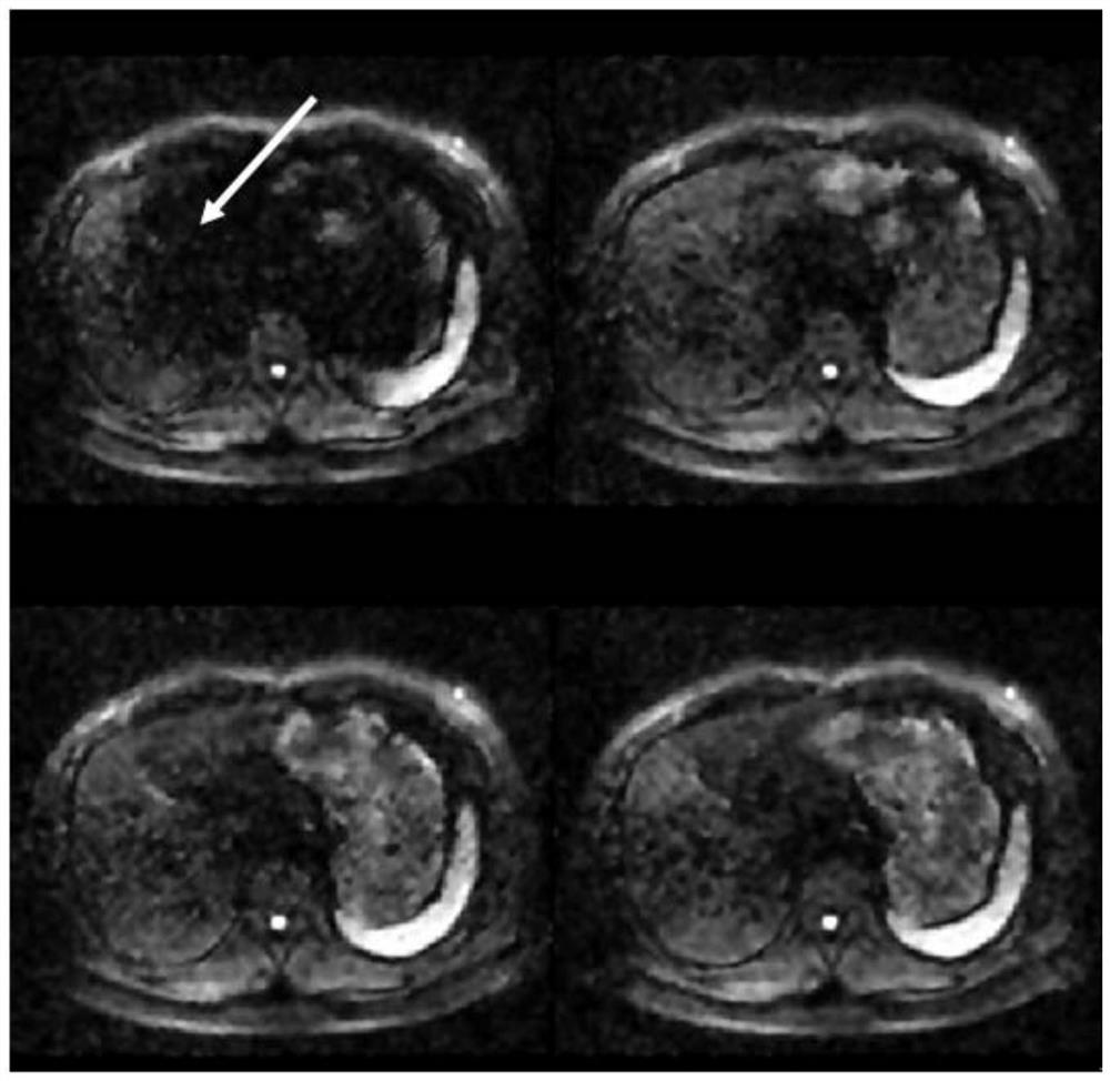 Adaptive Correction Method for MRI Diffusion Weighted Imaging