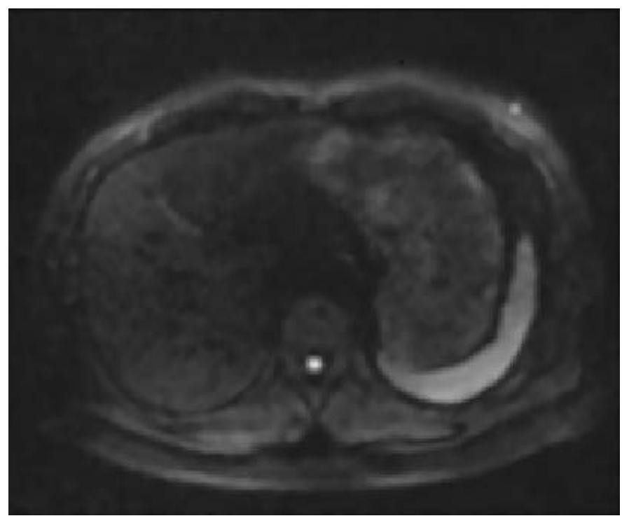 Adaptive Correction Method for MRI Diffusion Weighted Imaging