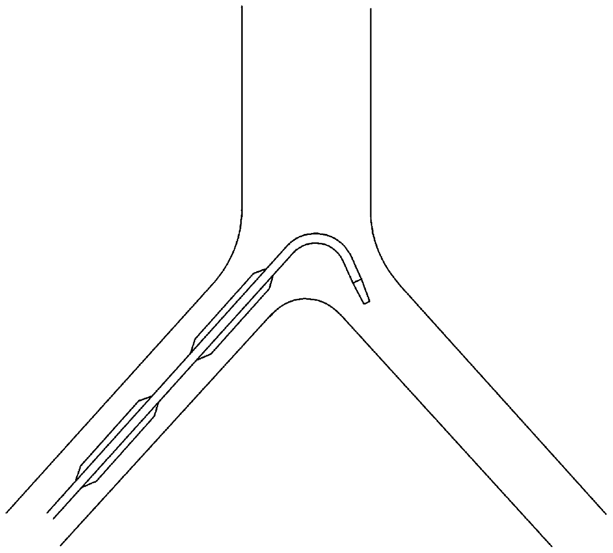 A double-balloon catheter for occlusion of blood flow in the common iliac artery