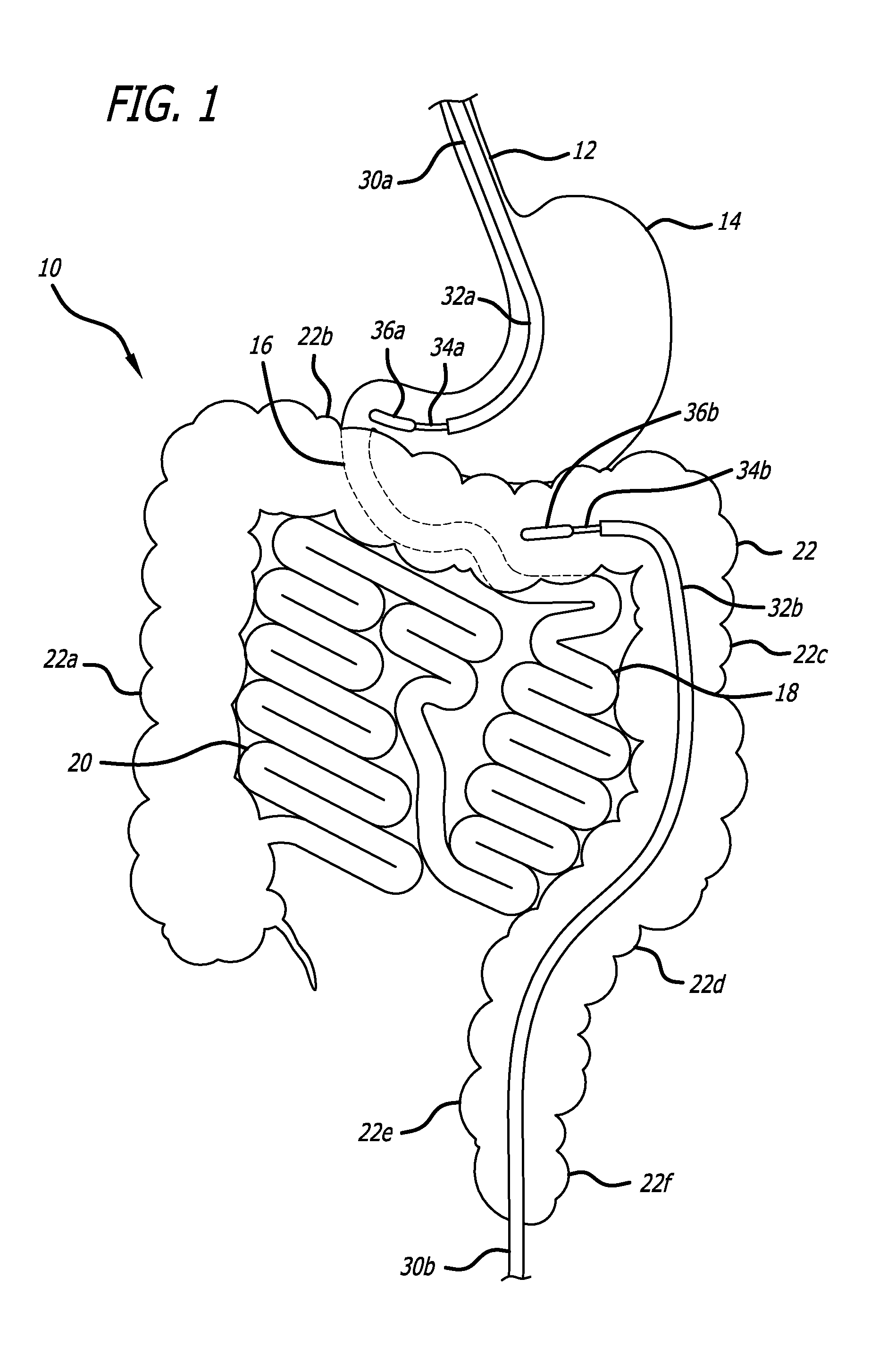 Incisionless Gastric Bypass Method And Devices