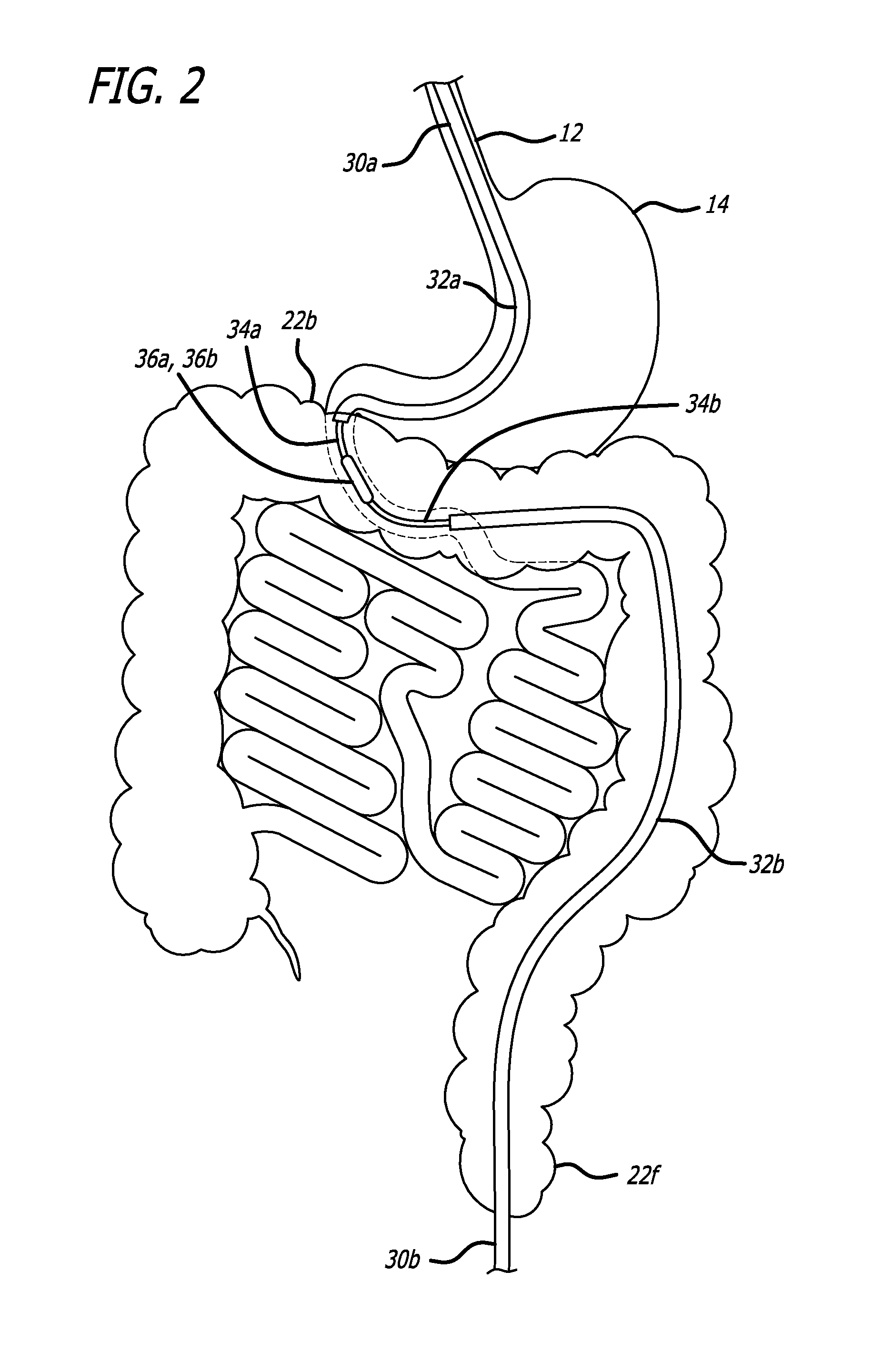 Incisionless Gastric Bypass Method And Devices