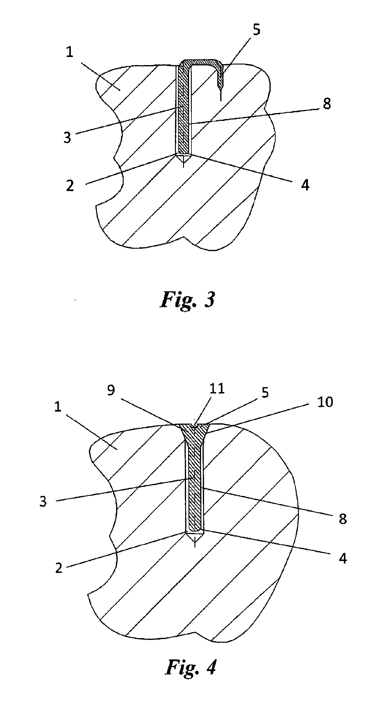 Electret implant for treatment of arthrosis