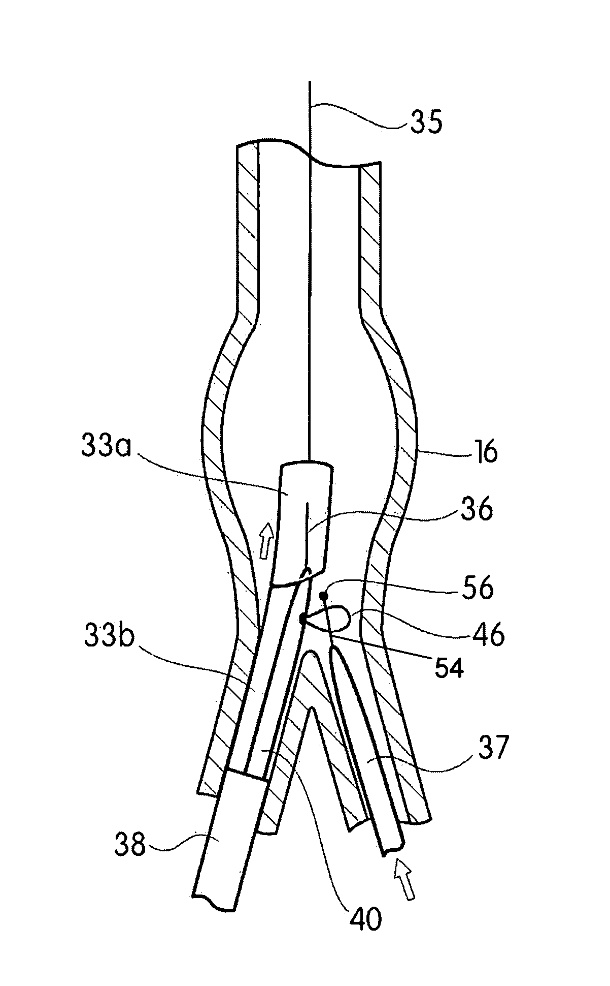 Apparatus and method for implantation of a bifurcated endovascular prosthesis