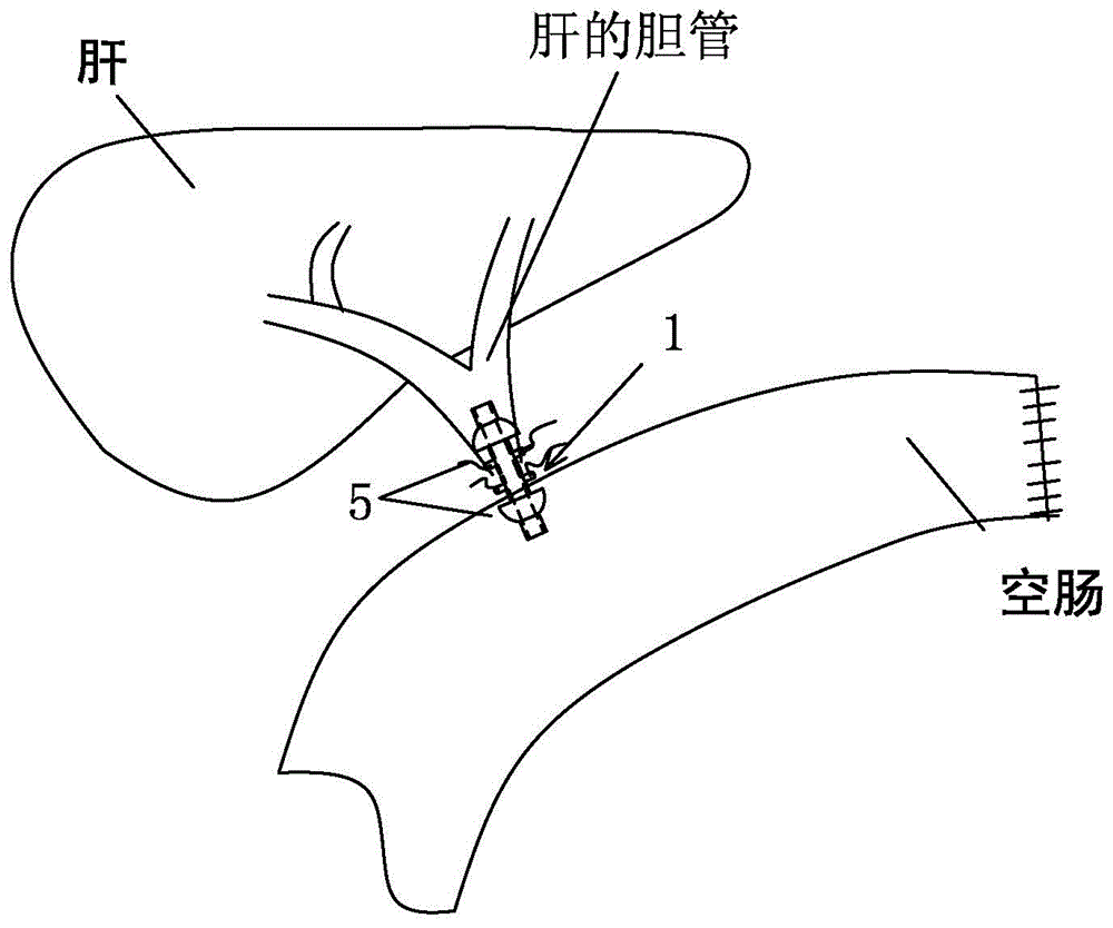 Suture-free bilioenteric anastomosis stent manufactured through 3D (three-dimensional) printing and manufacturing method thereof