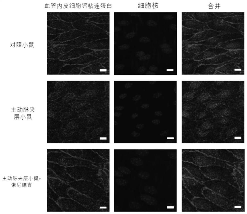 Pharmaceutical application of Sonidegib in treatment of aortic dissection