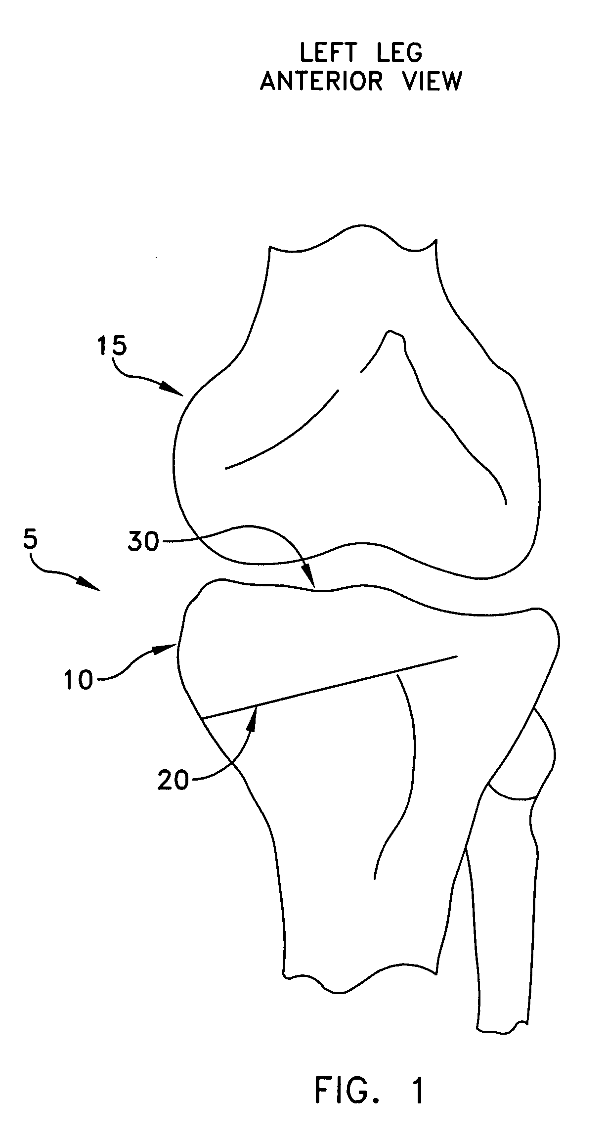 Method and apparatus for performing an open wedge, high tibial osteotomy