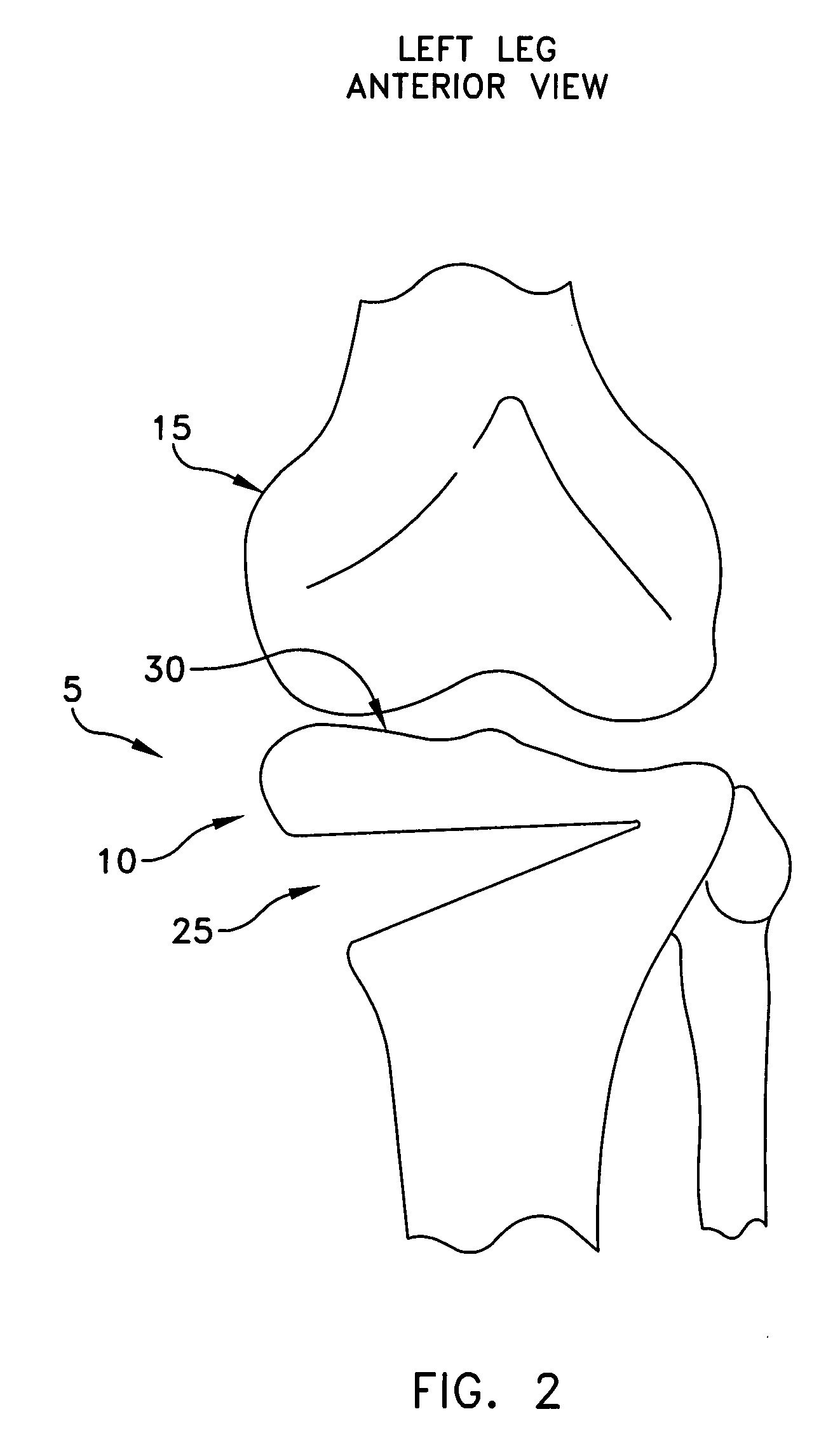 Method and apparatus for performing an open wedge, high tibial osteotomy