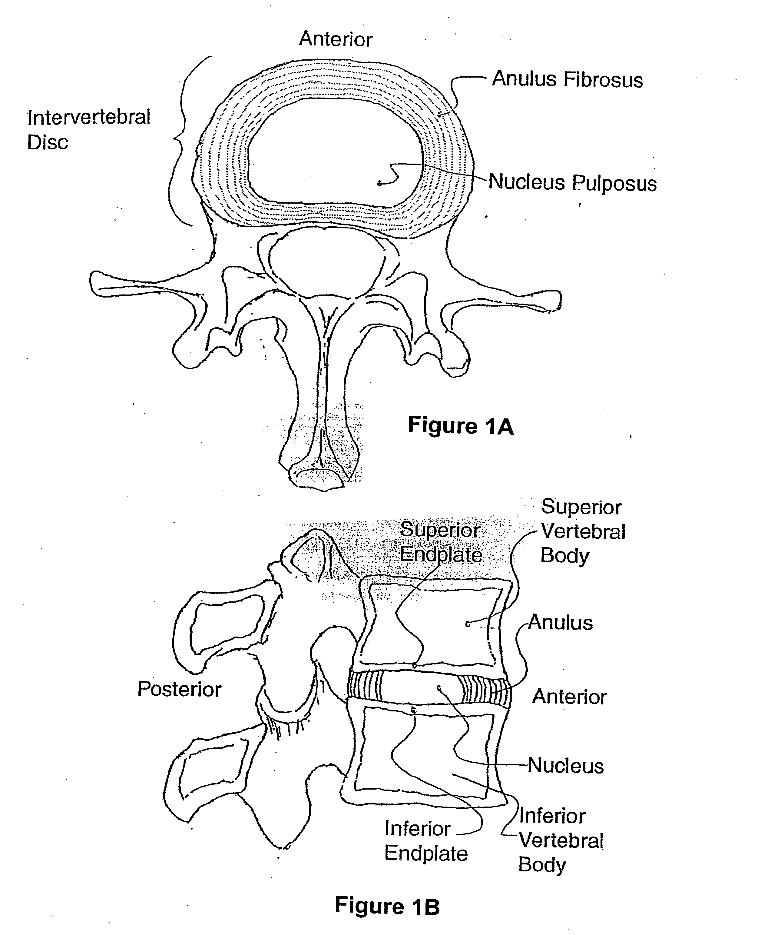 Selective delivery of cryogenic energy to intervertebral disc tissue and related methods of intradiscal hypothermia therapy