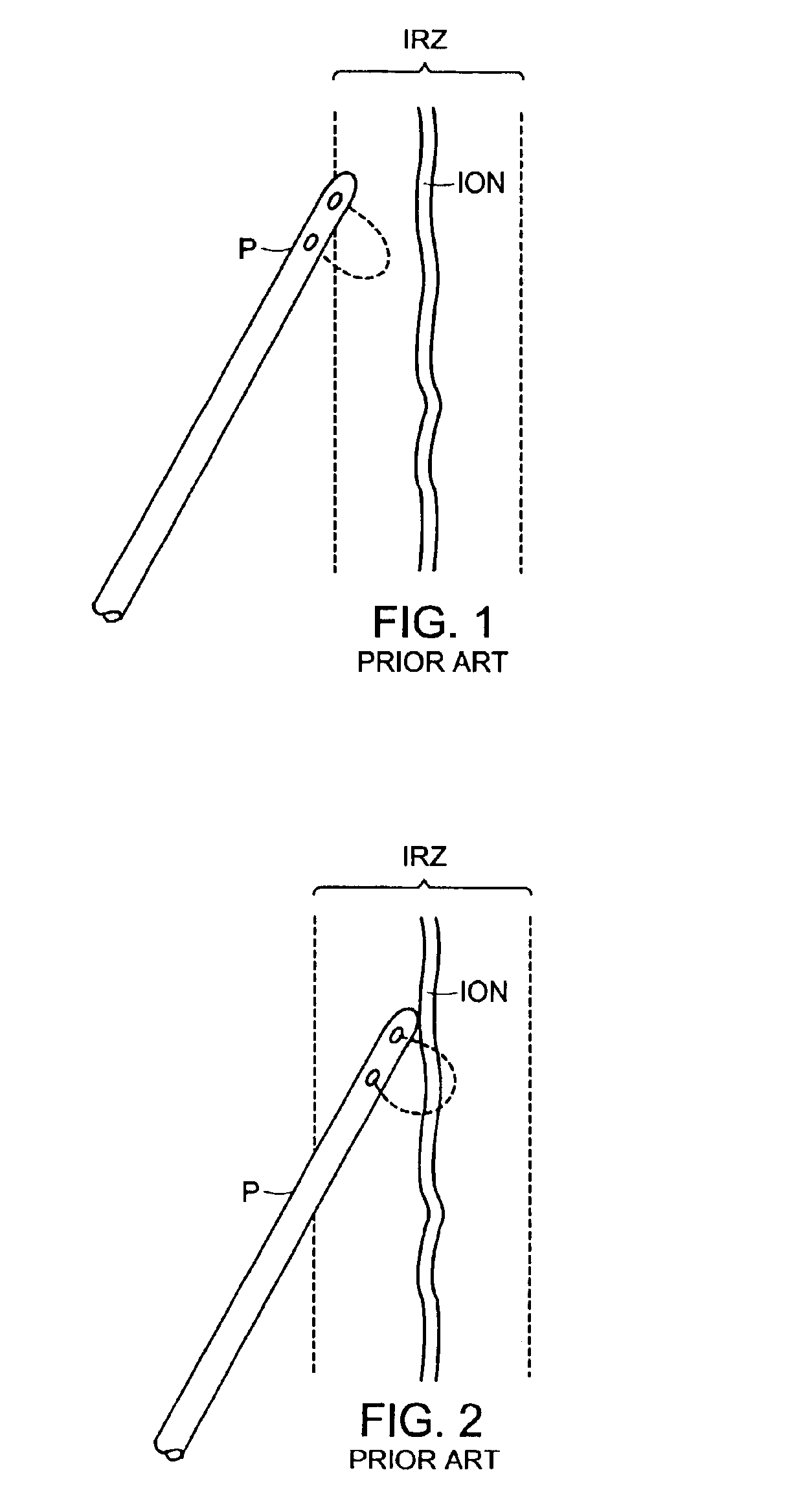 Method of straddling an intraosseous nerve