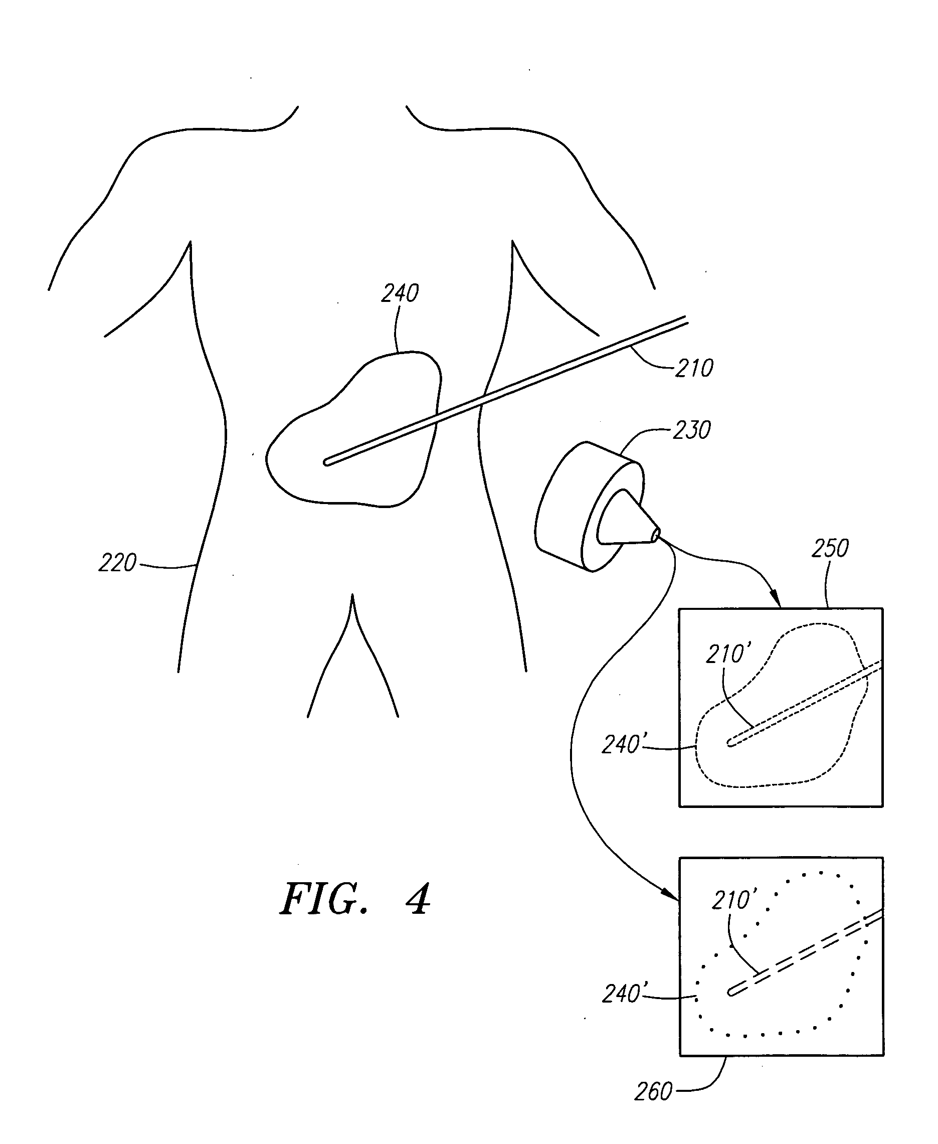 Ultrasound coating for enhancing visualization of medical device in ultrasound images