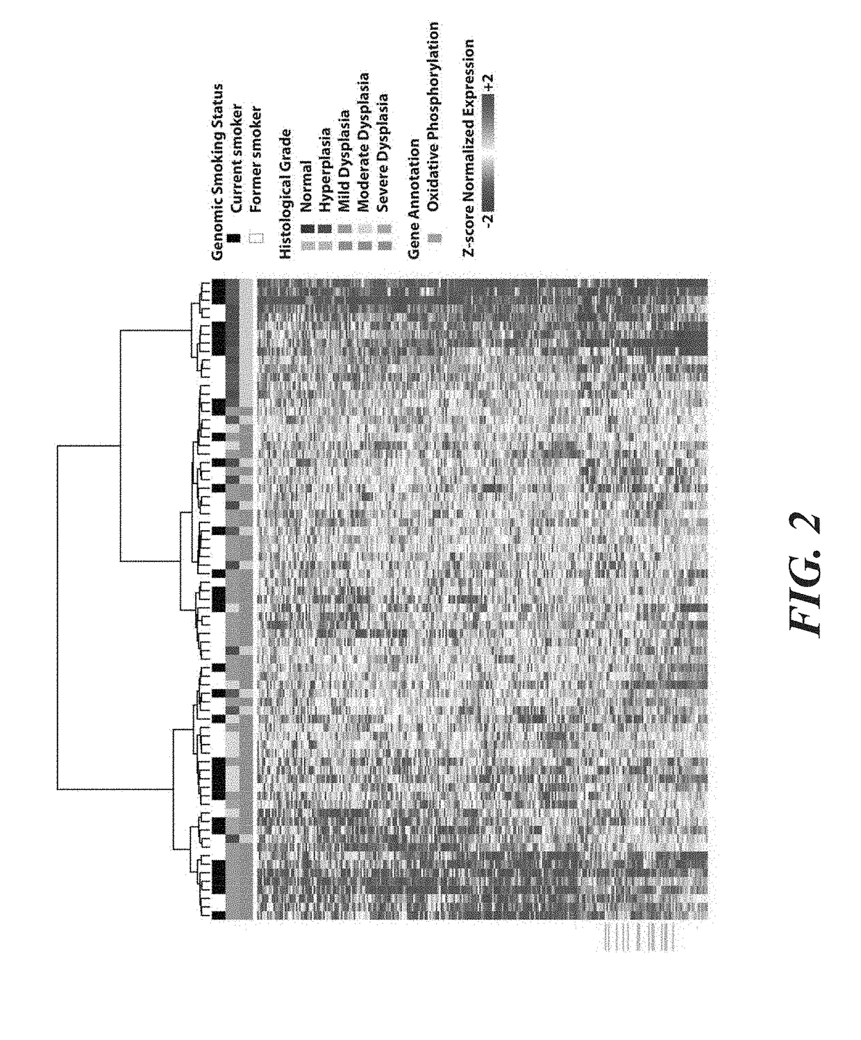 Gene expression-based biomarker for the detection and monitoring of bronchial premalignant lesions