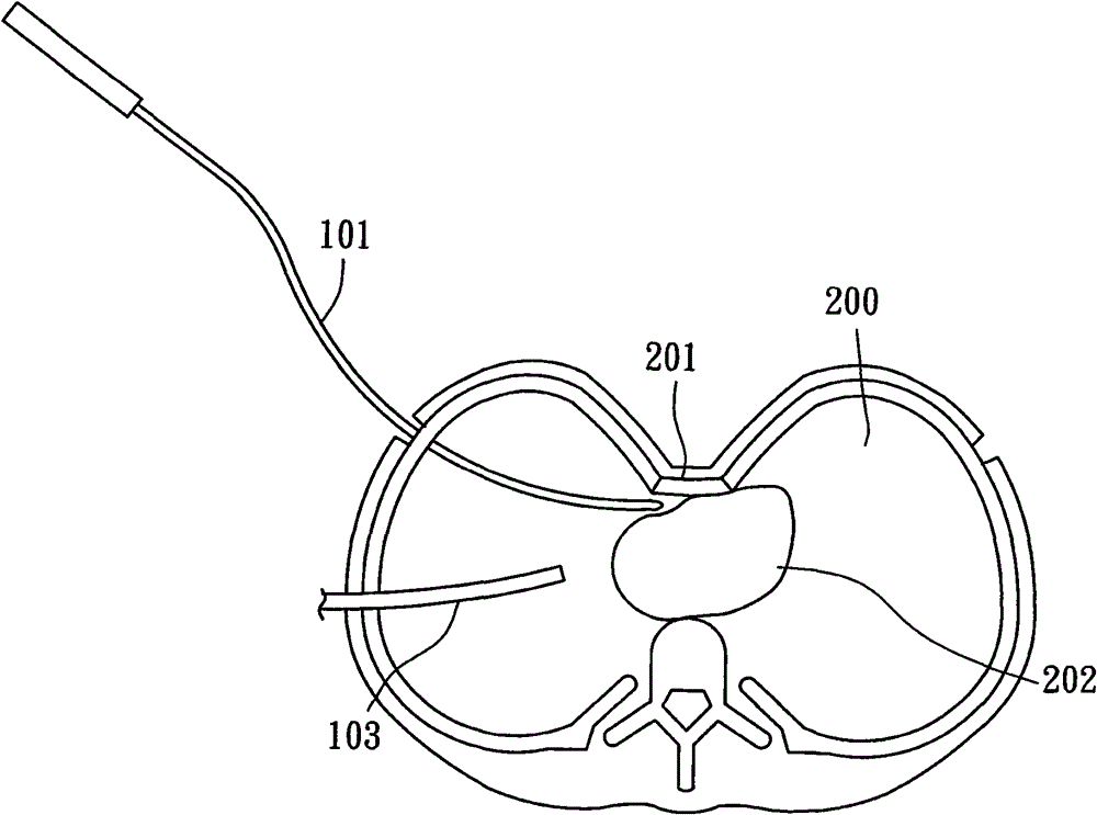 Guide device for correcting pectus excavatum